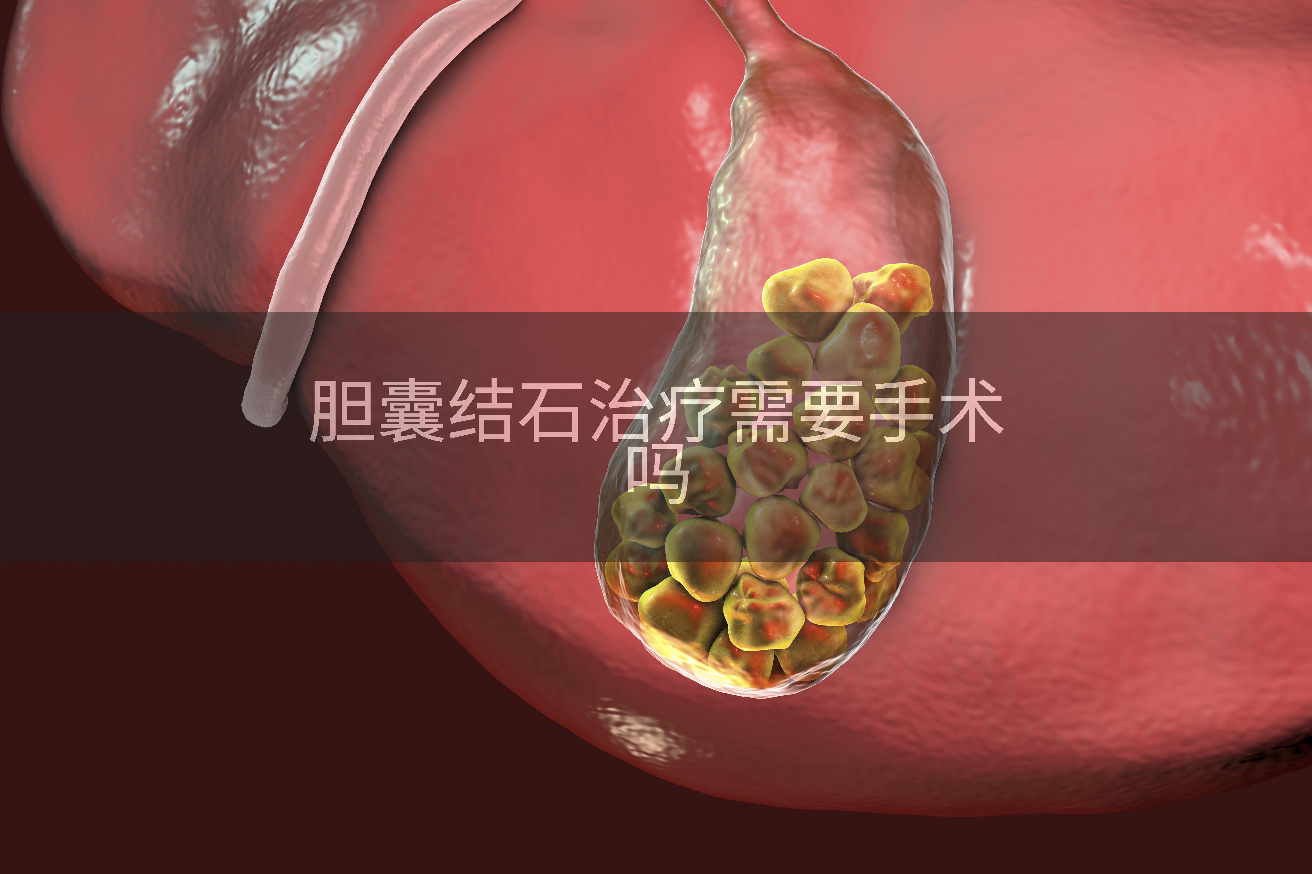 胆囊结石治疗需要手术吗