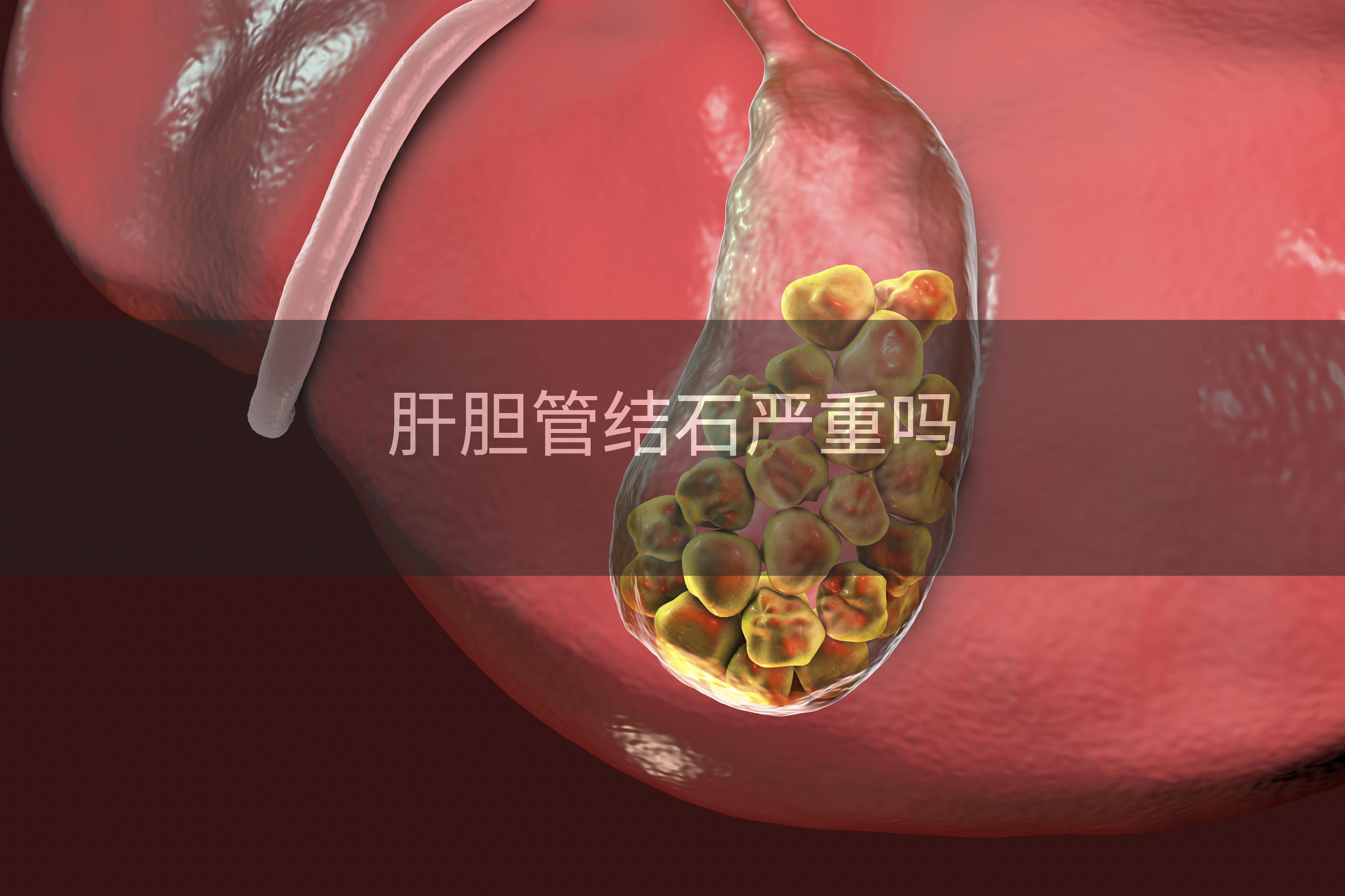 肝胆管结石严重吗