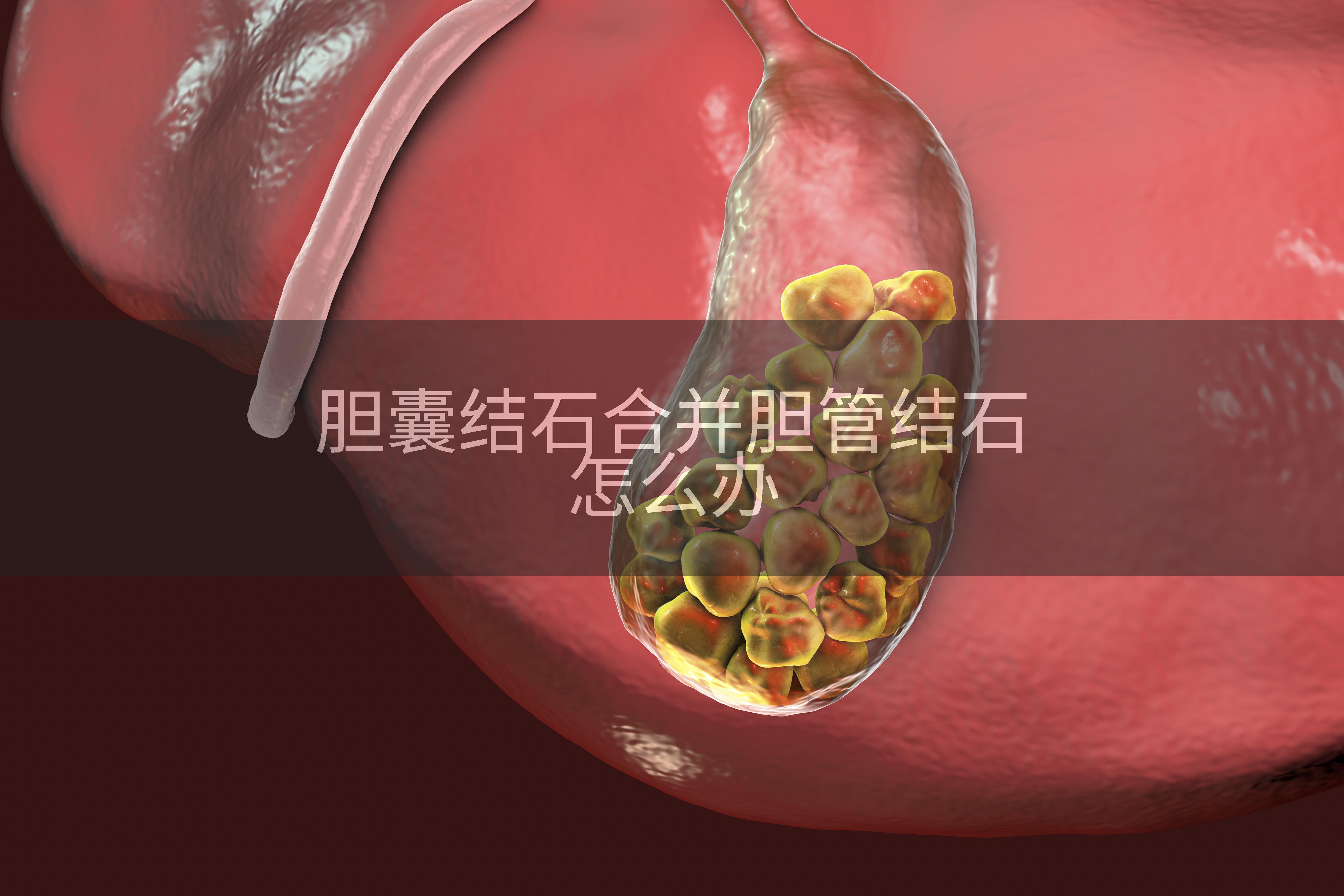 胆囊结石合并胆管结石怎么办