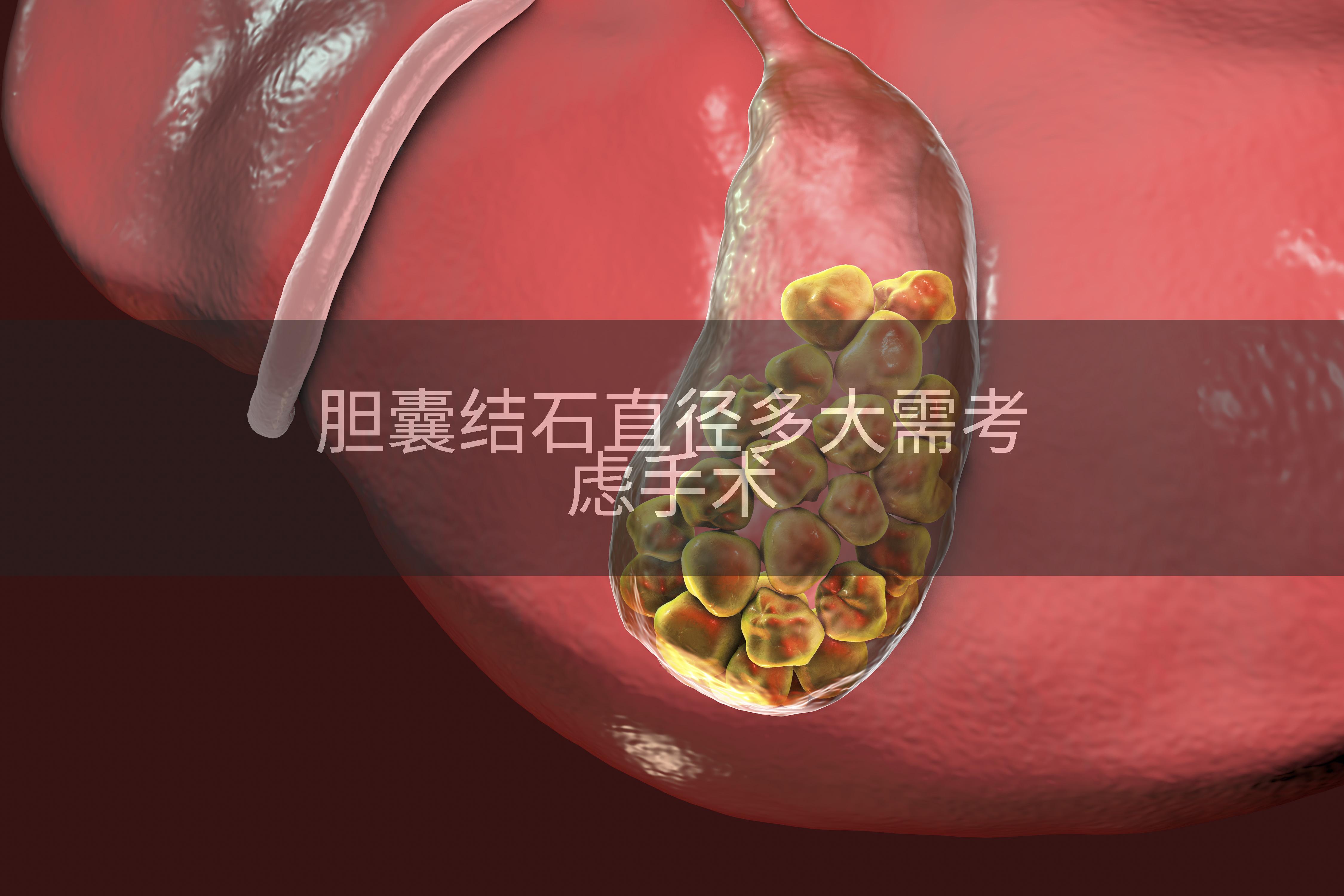 胆囊结石直径多大需考虑手术