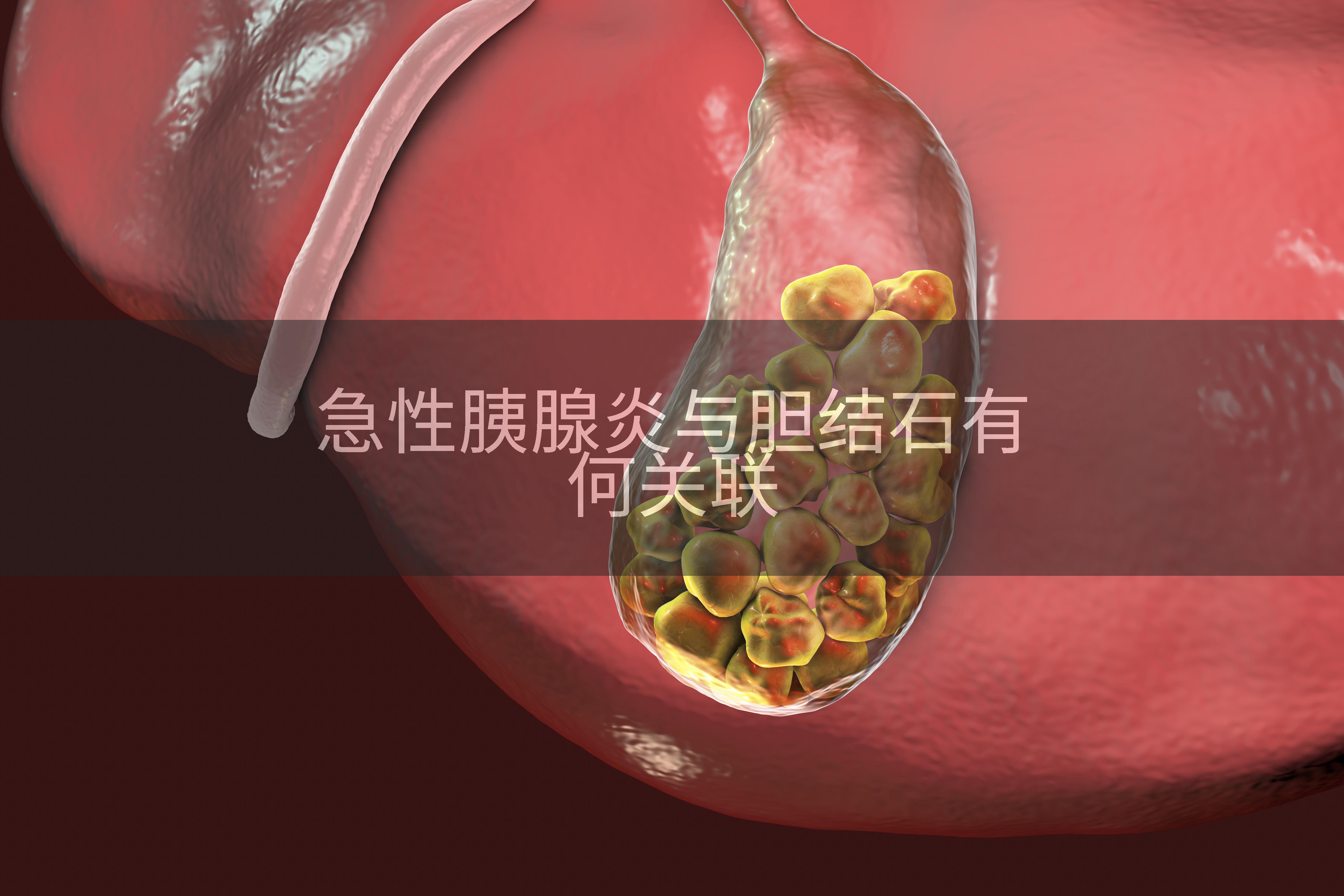 急性胰腺炎与胆结石有何关联