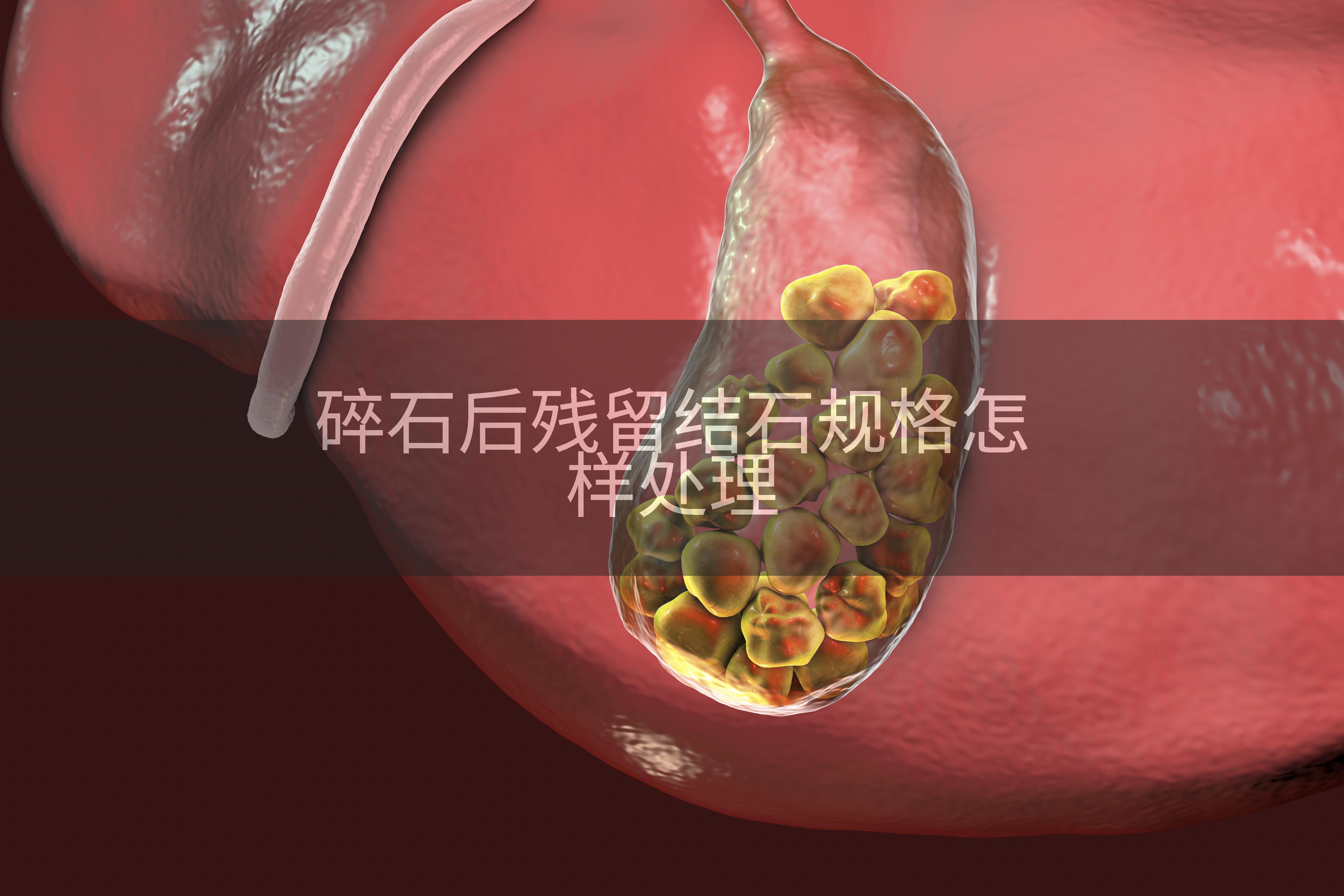 碎石后残留结石规格怎样处理