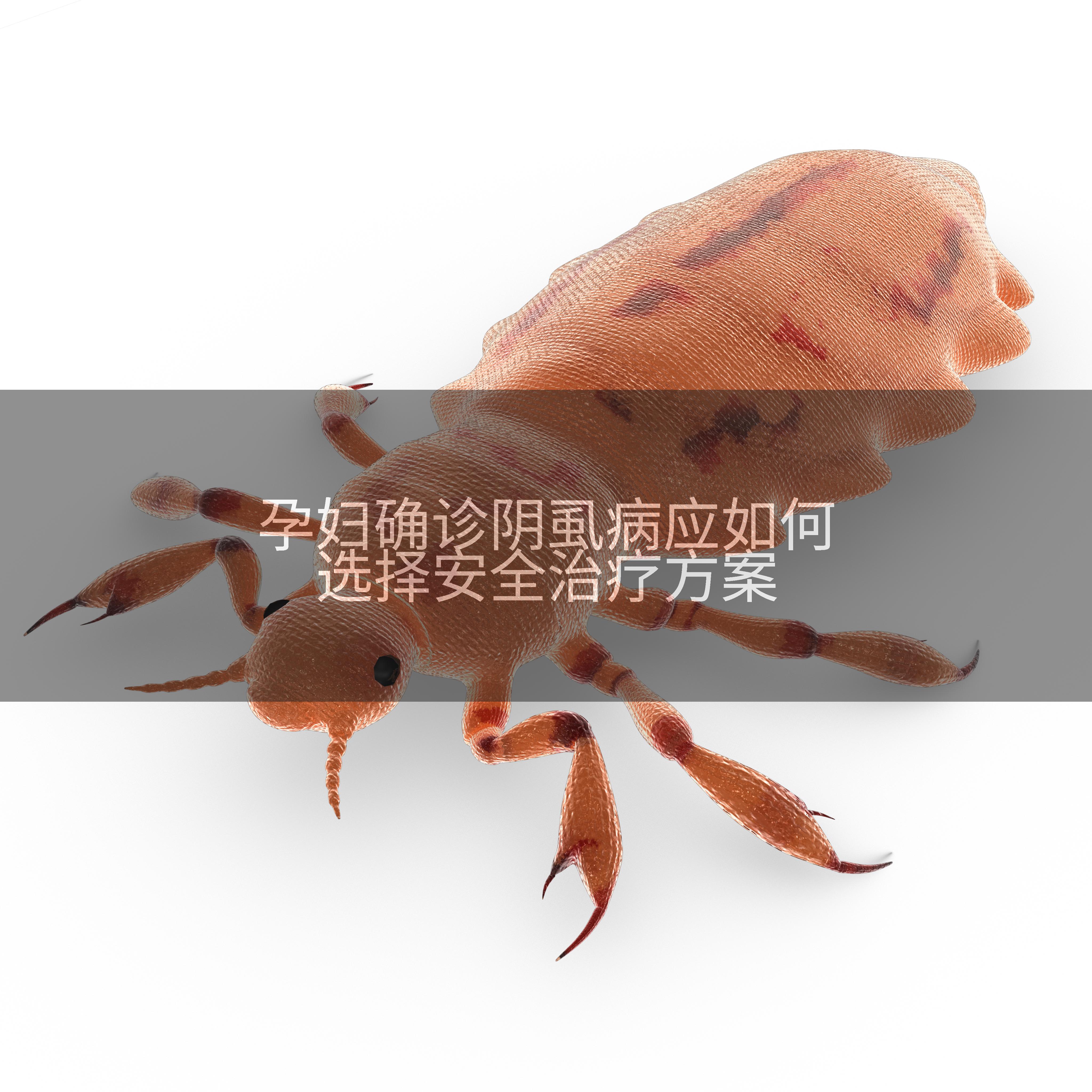 孕妇确诊阴虱病应如何选择安全治疗方案