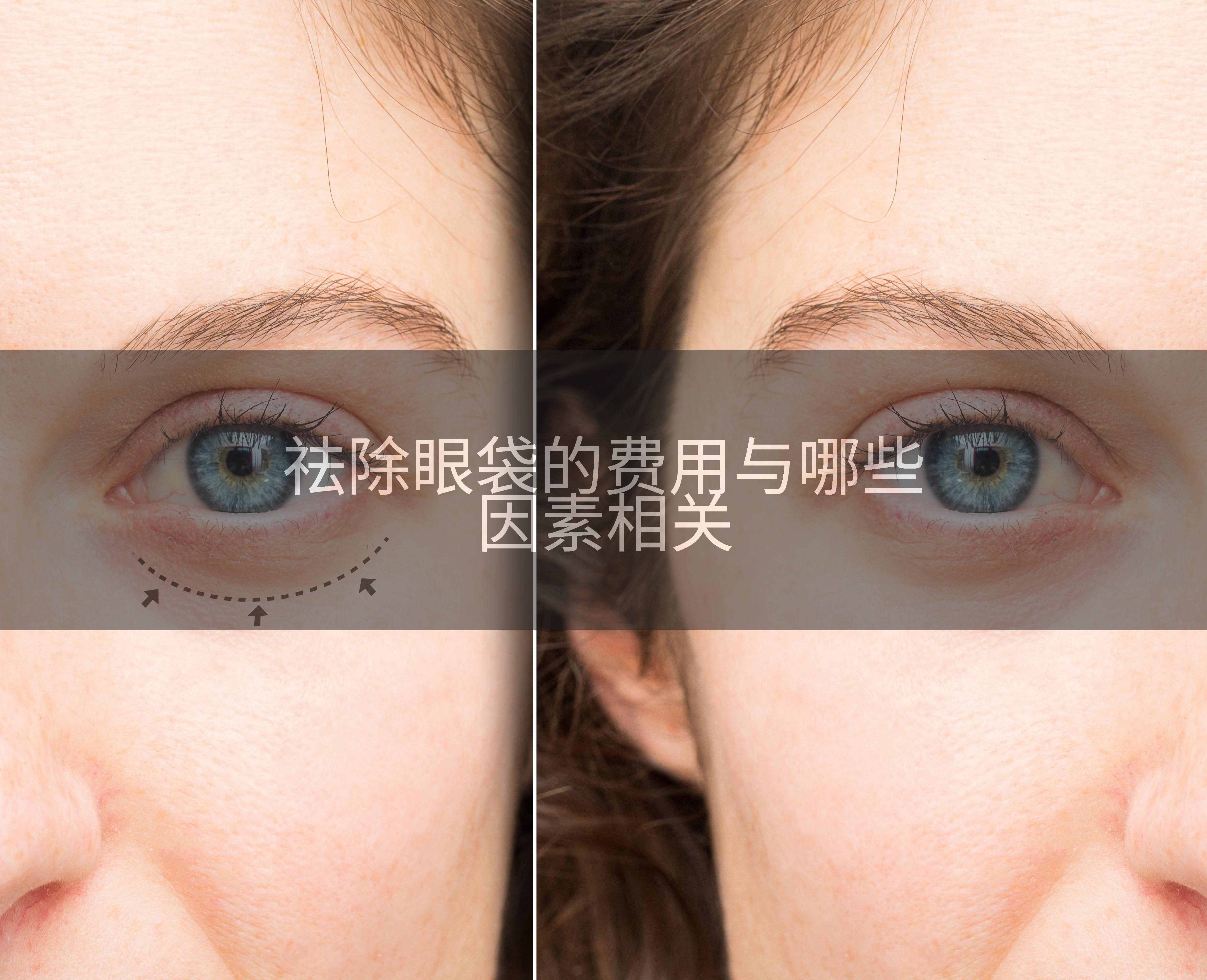 祛除眼袋的费用与哪些因素相关