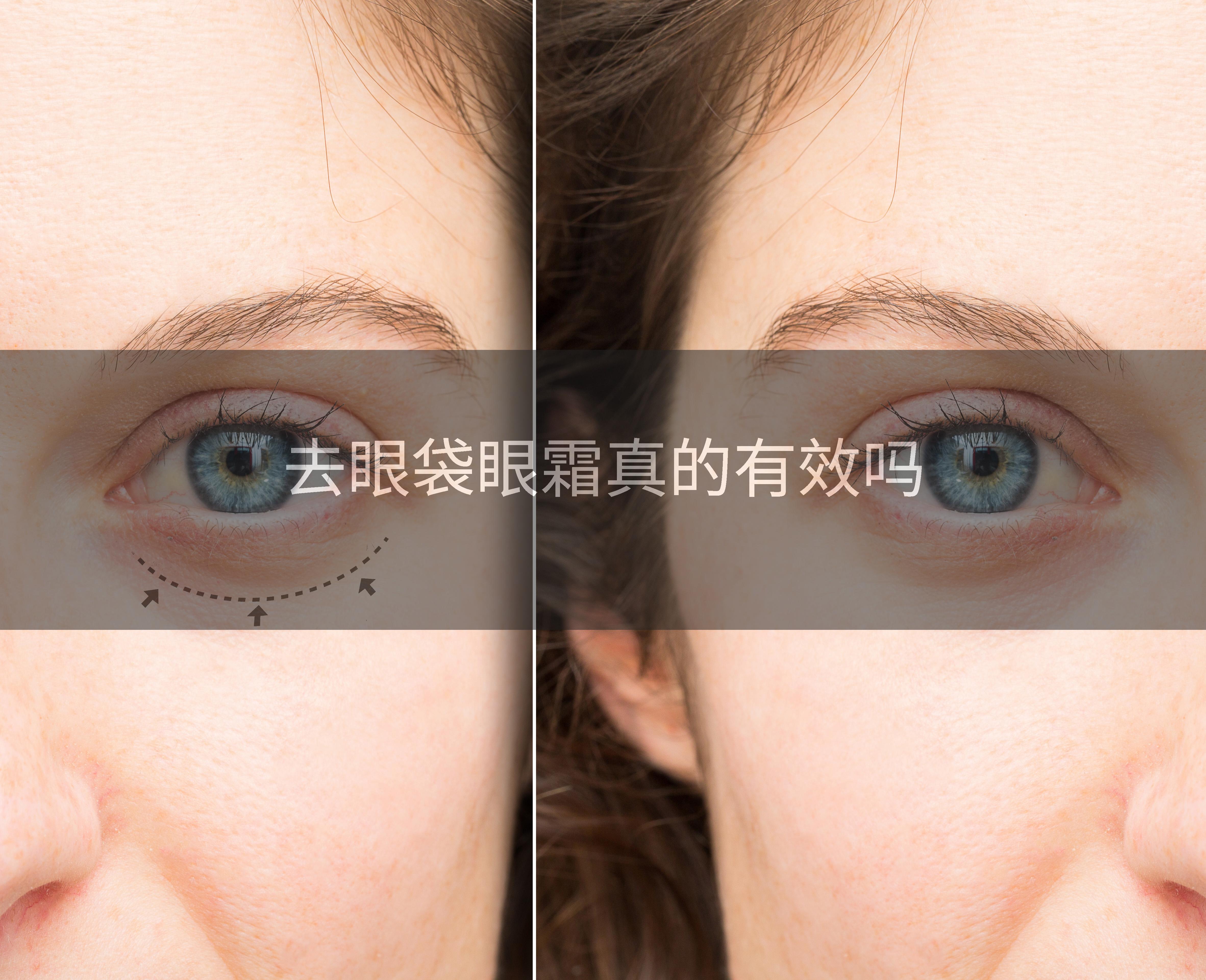 去眼袋眼霜真的有效吗