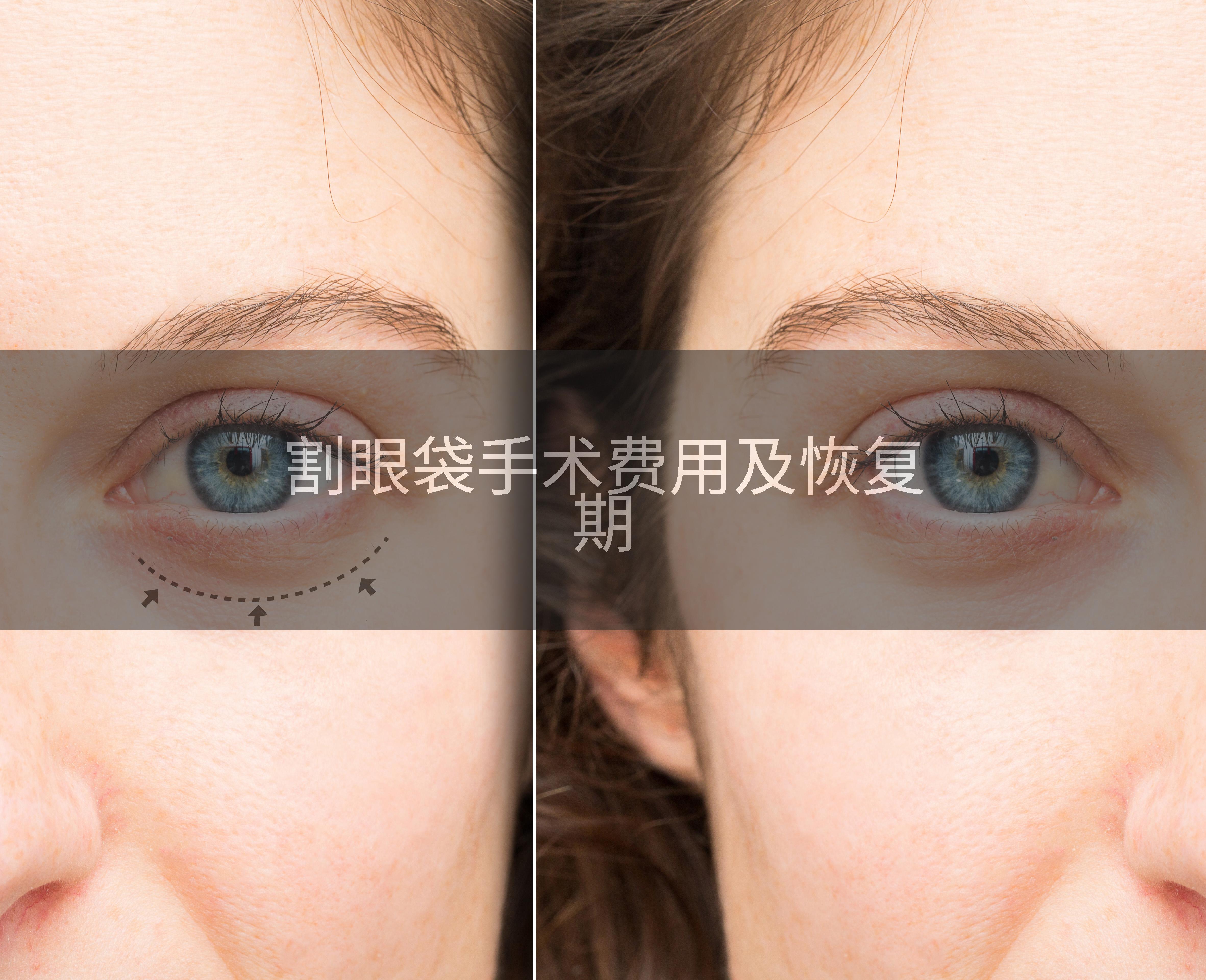 割眼袋手术费用及恢复期