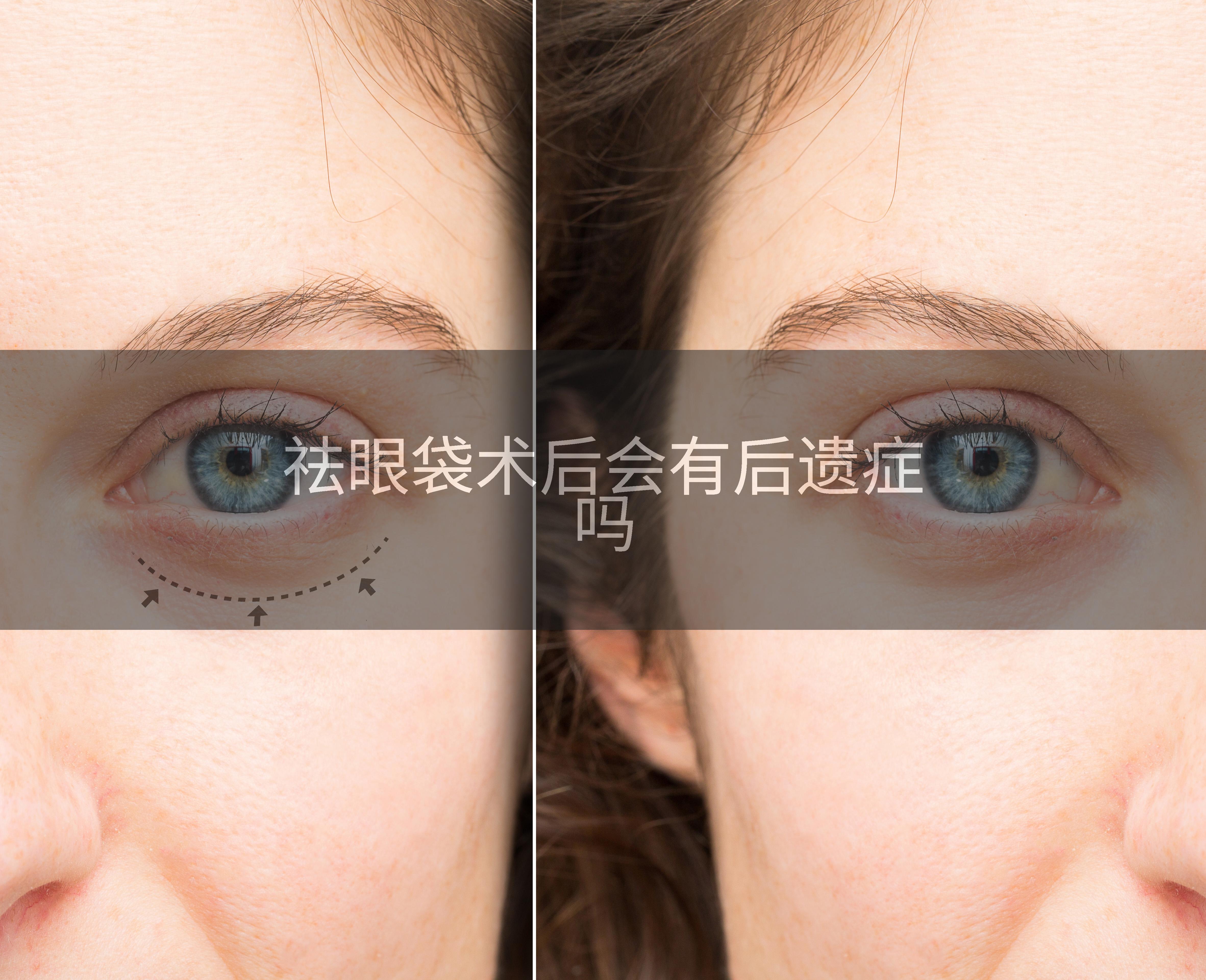 祛眼袋术后会有后遗症吗