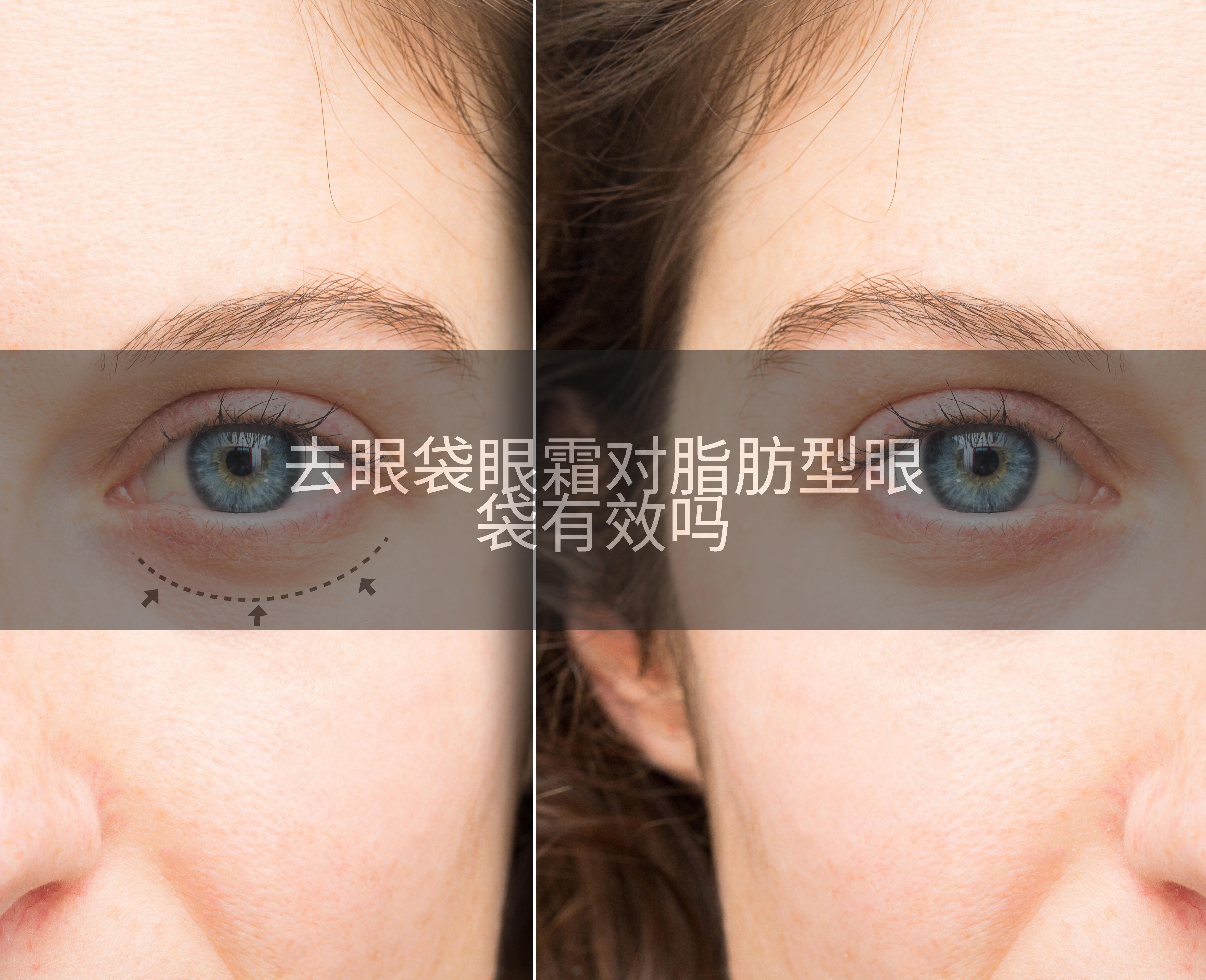 去眼袋眼霜对脂肪型眼袋有效吗