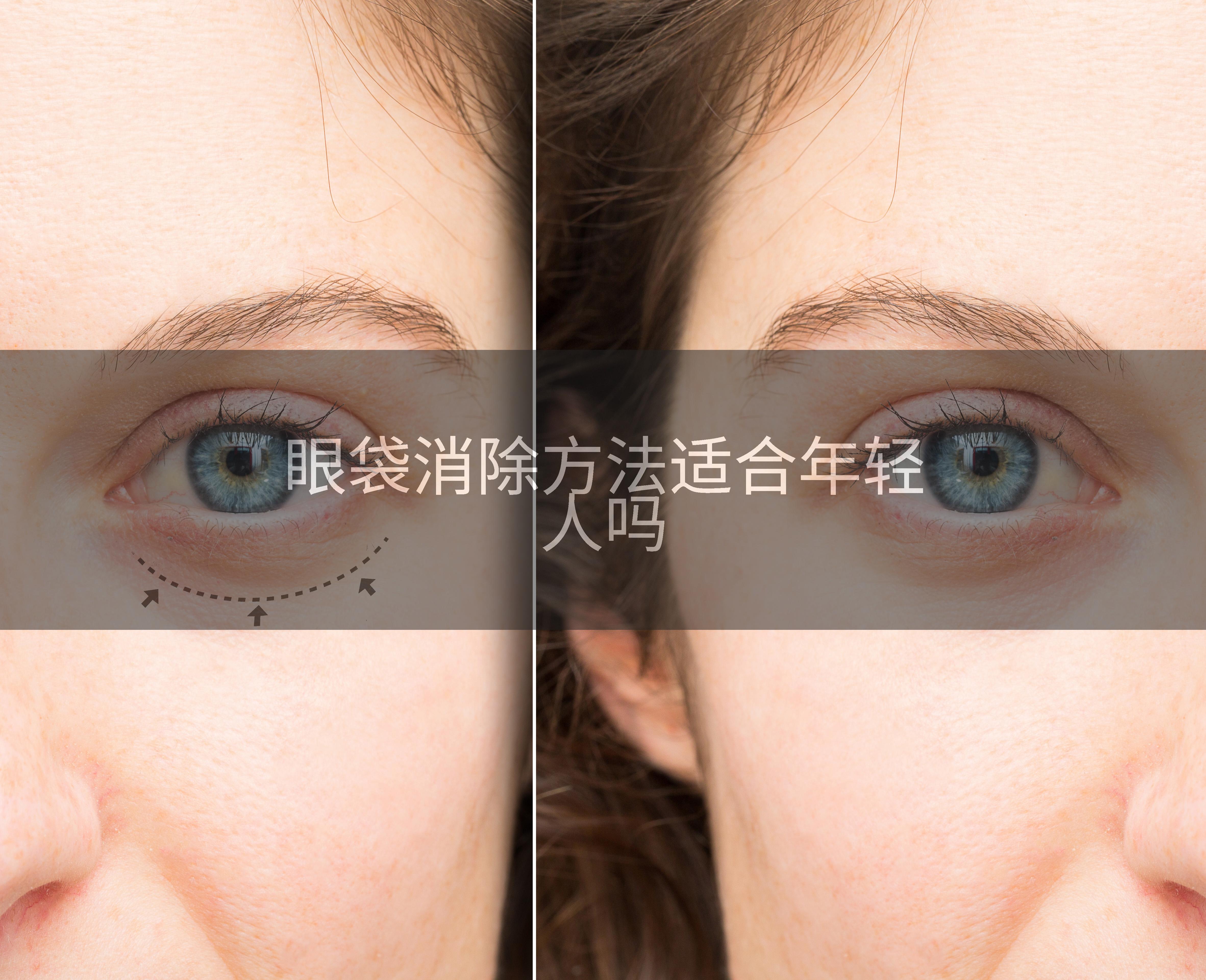 眼袋消除方法适合年轻人吗