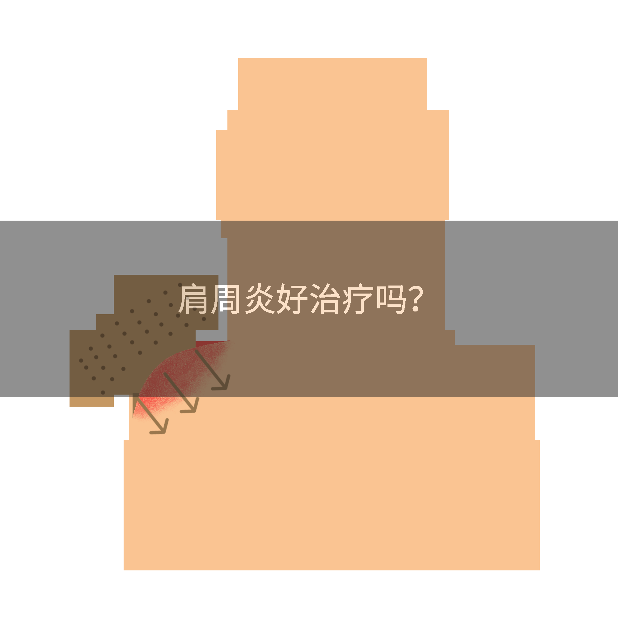 肩周炎好治疗吗？