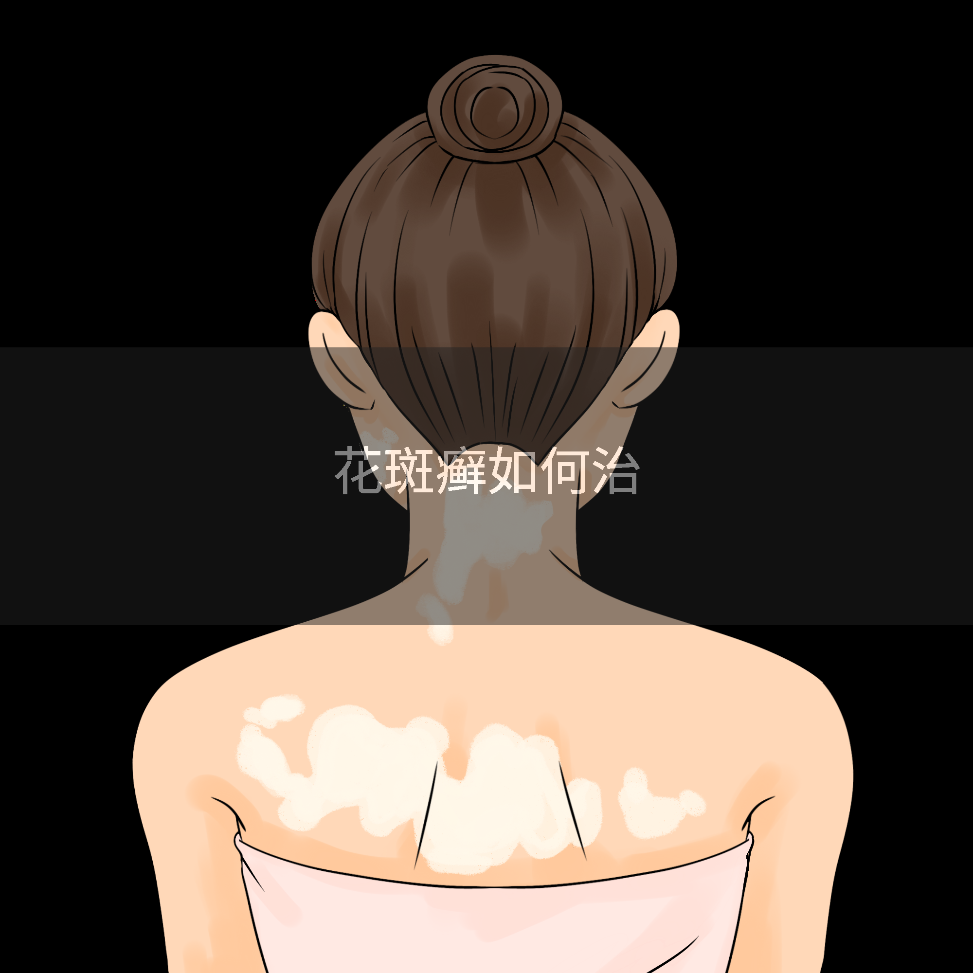 花斑癣如何治