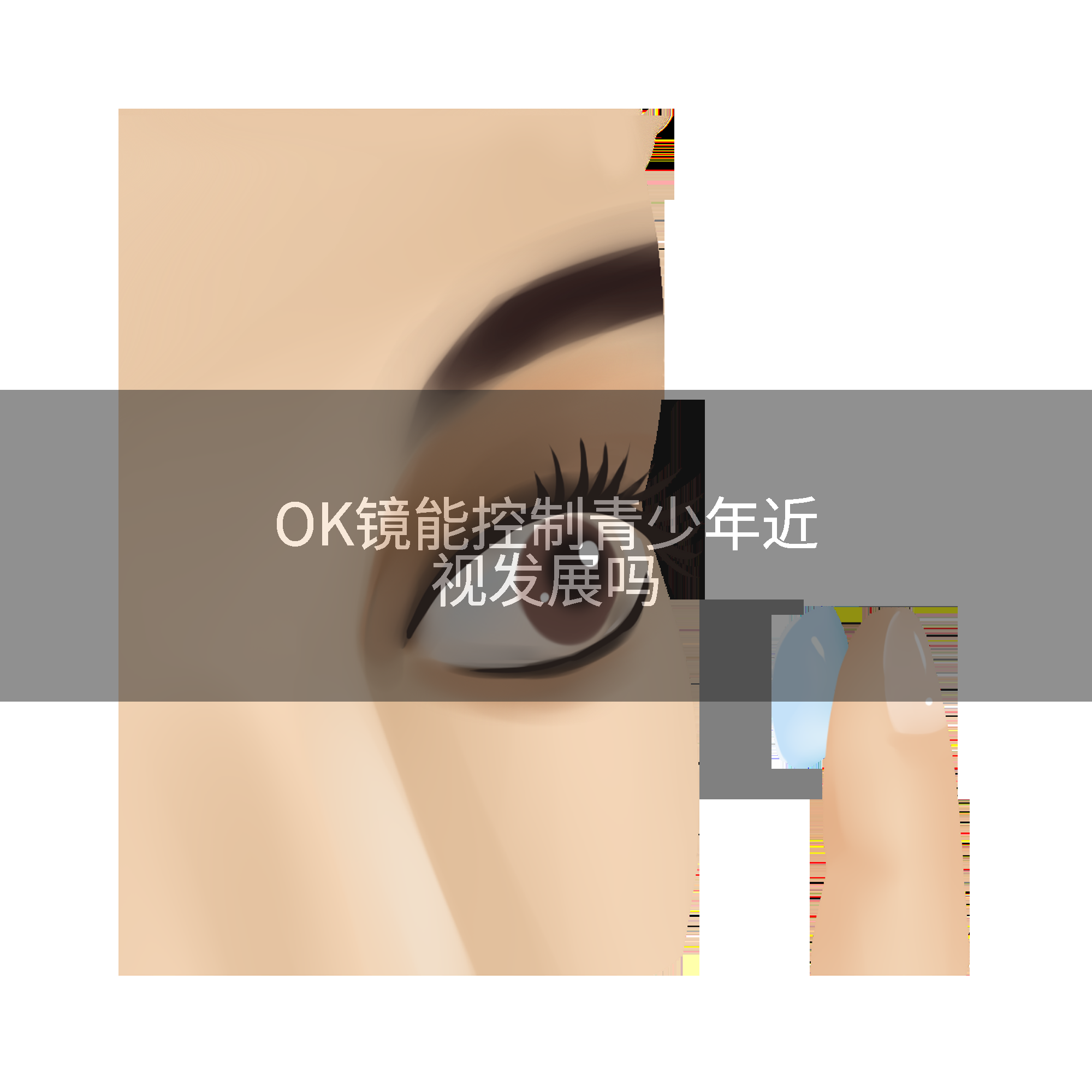 OK镜能控制青少年近视发展吗
