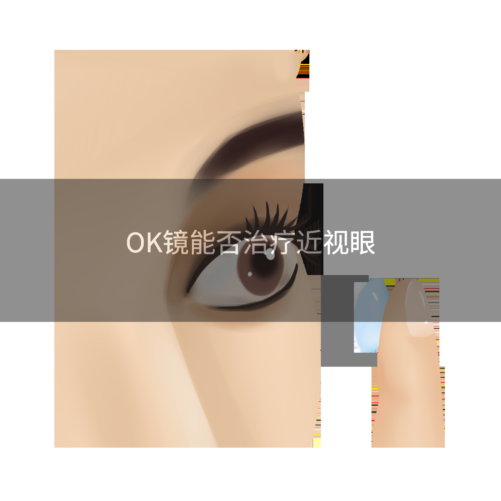 OK镜能否治疗近视眼