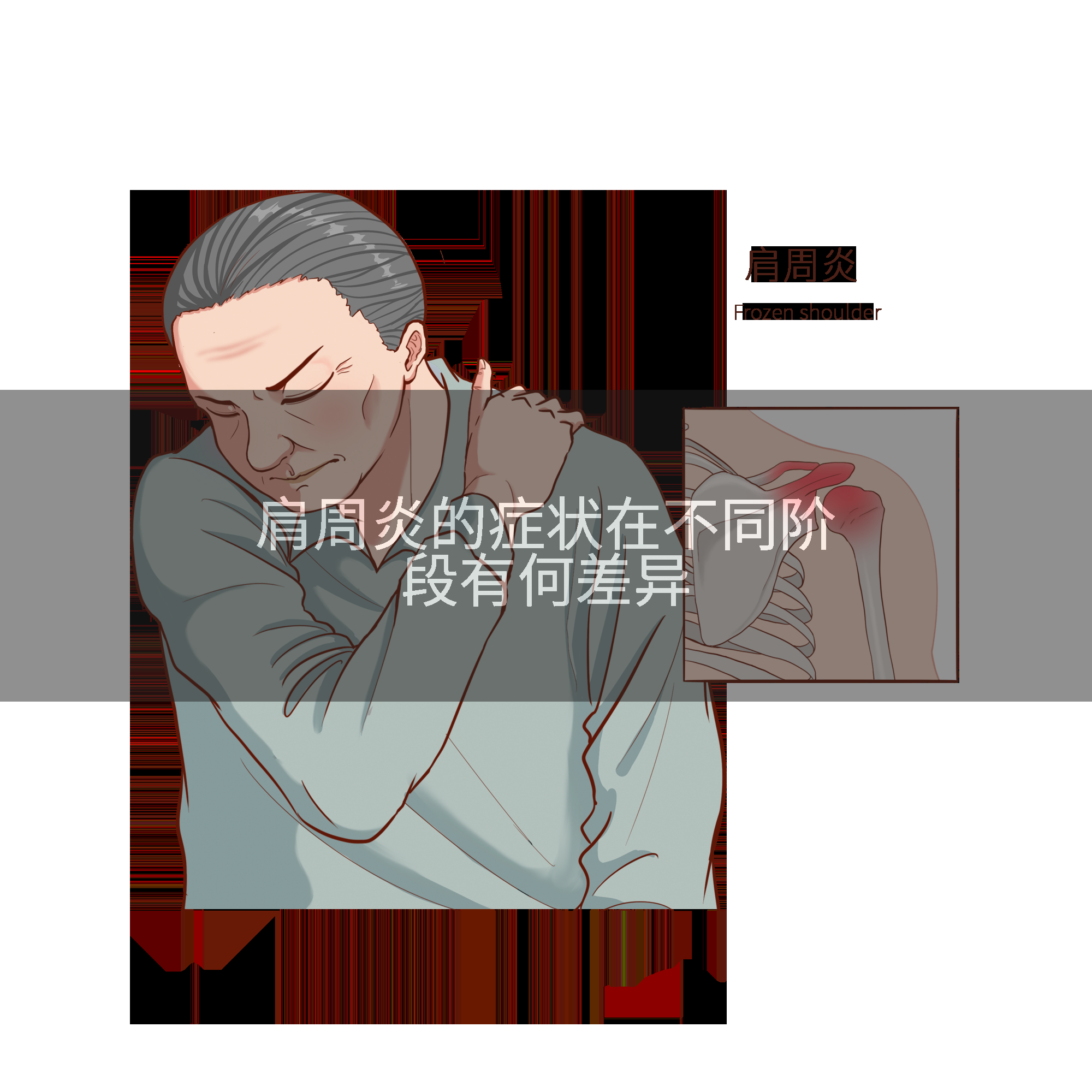 肩周炎的症状在不同阶段有何差异