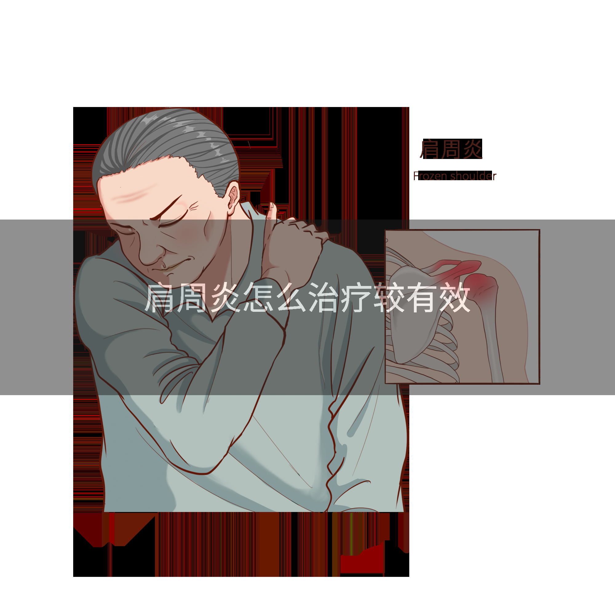 肩周炎怎么治疗较有效