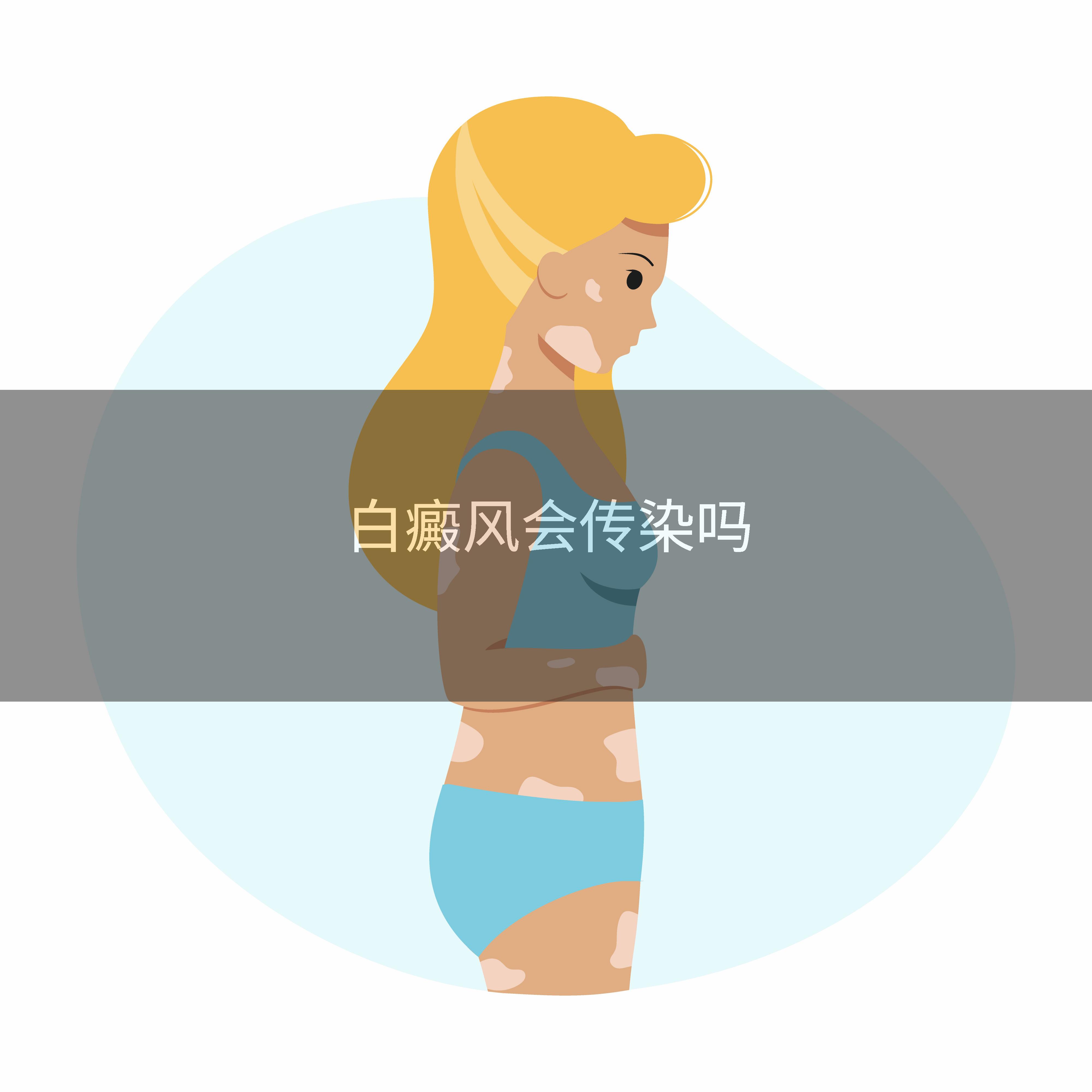 白癜风会传染吗