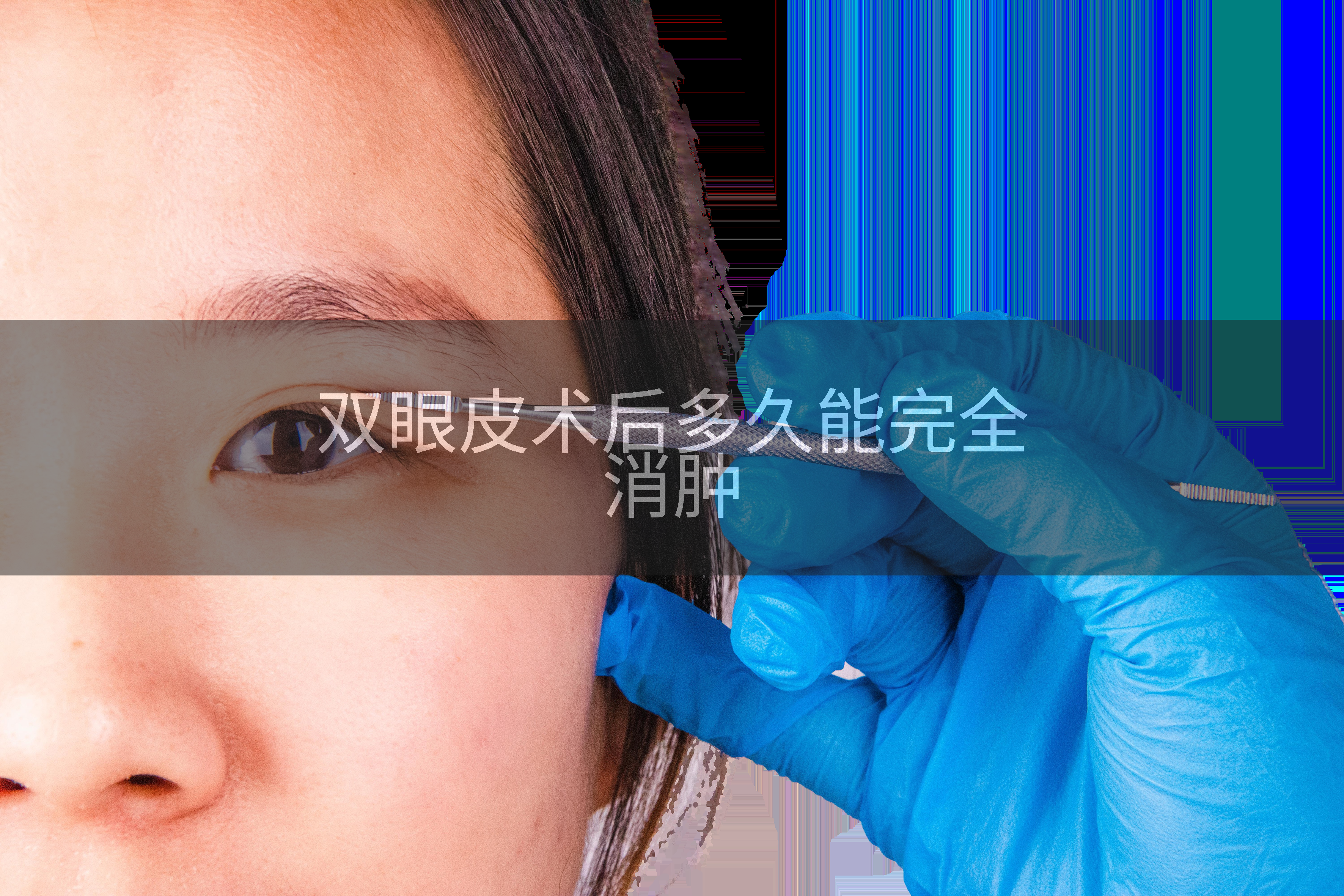 双眼皮术后多久能完全消肿