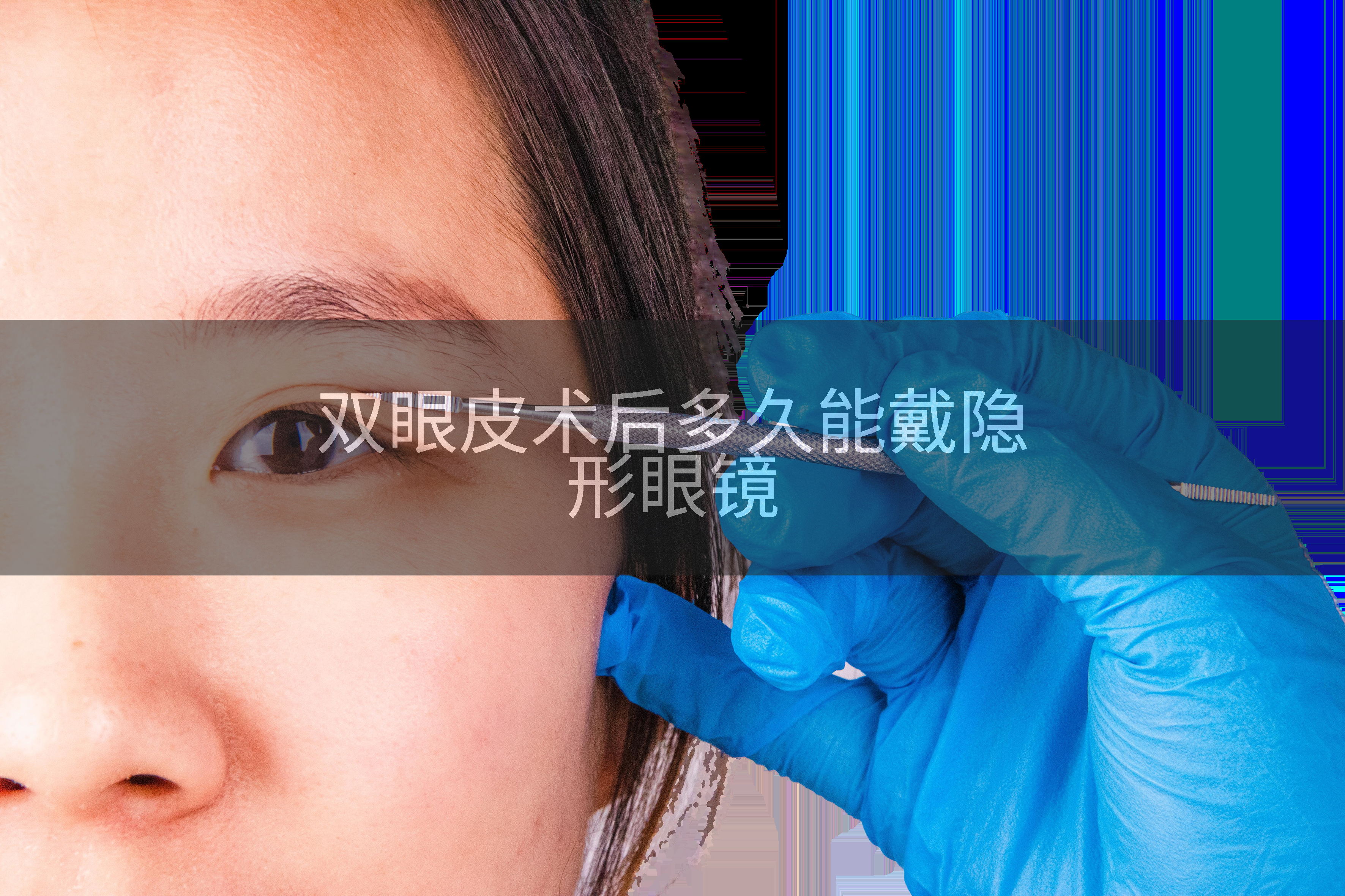 双眼皮术后多久能戴隐形眼镜