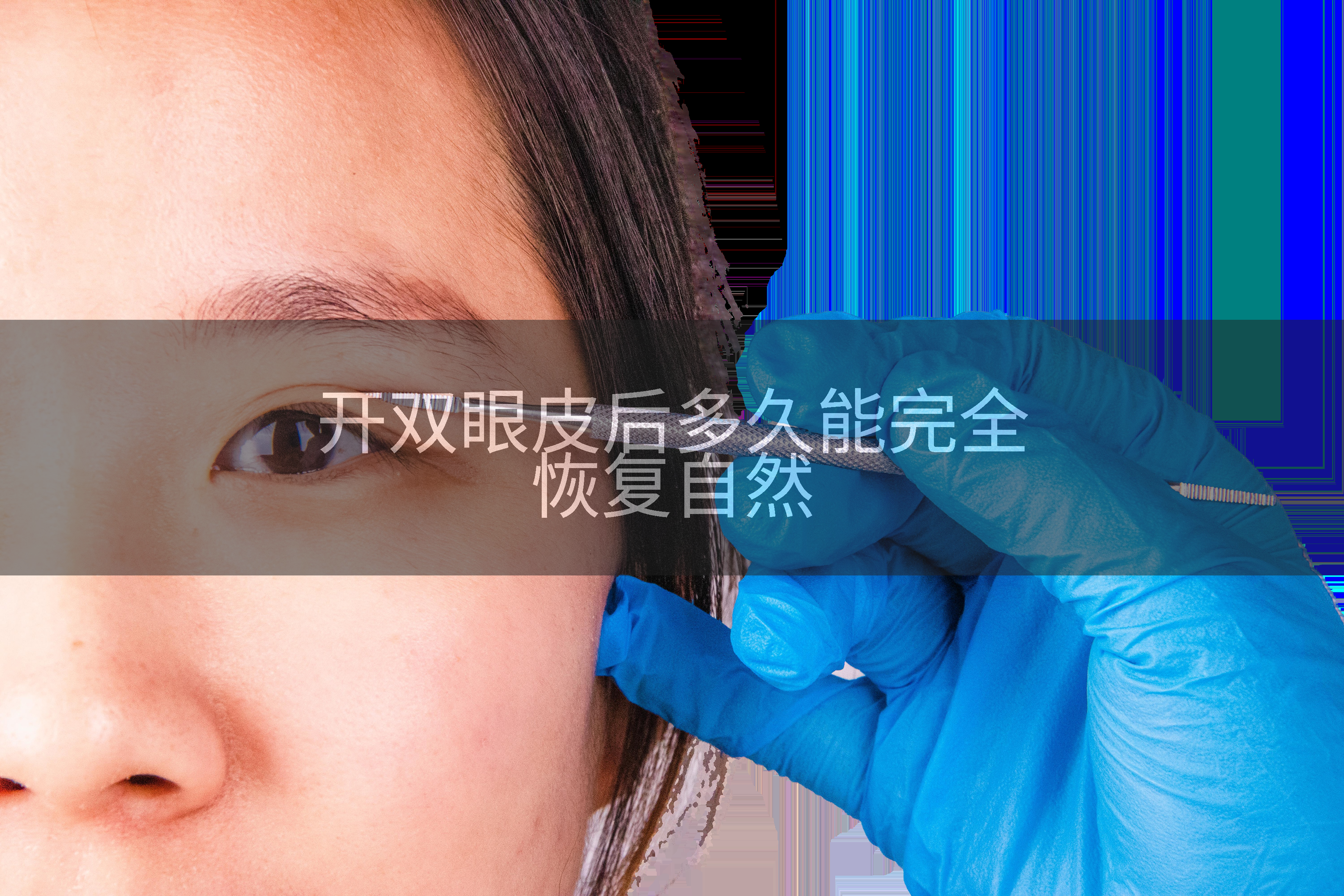 开双眼皮后多久能完全恢复自然