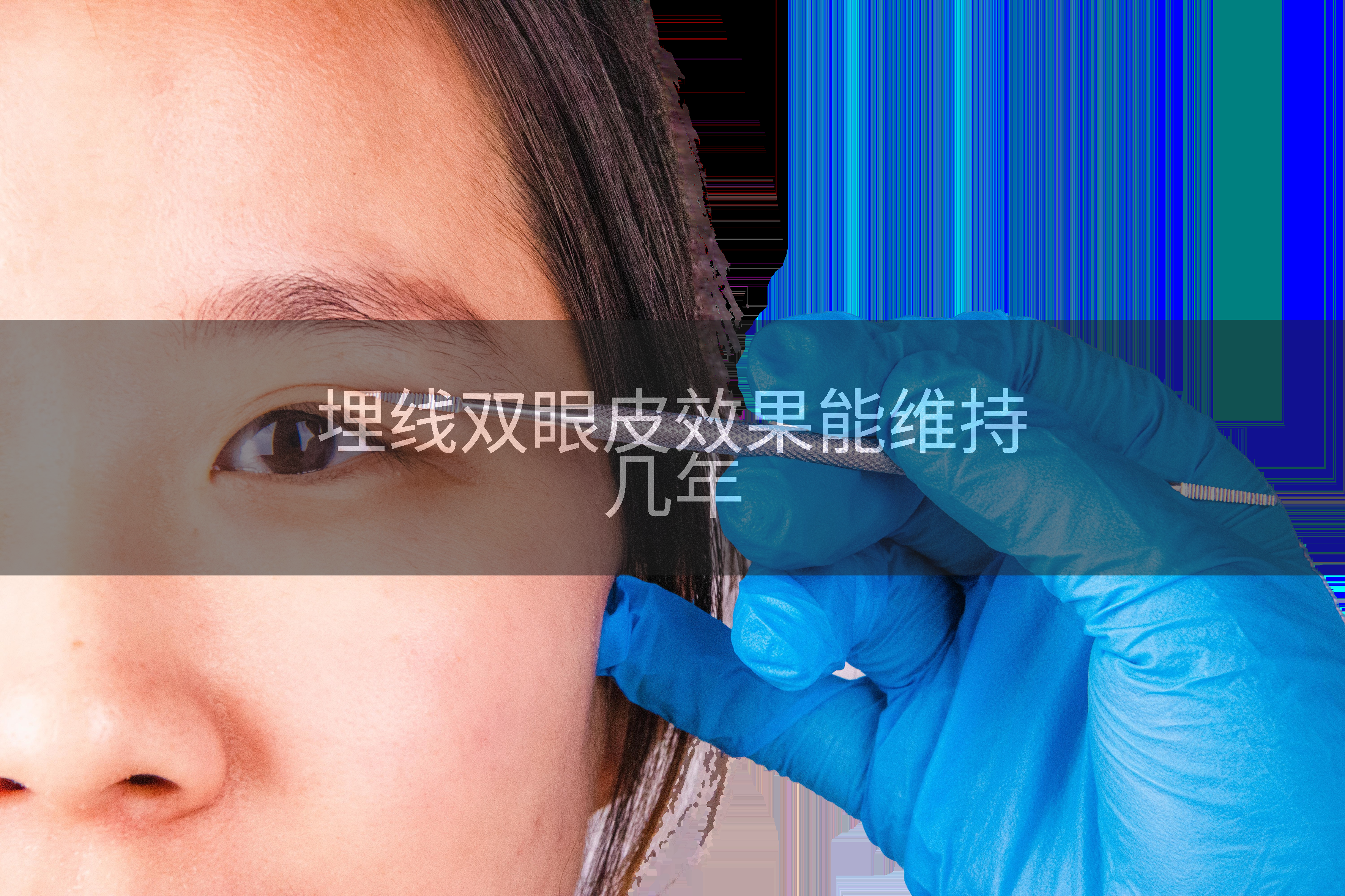 埋线双眼皮效果能维持几年