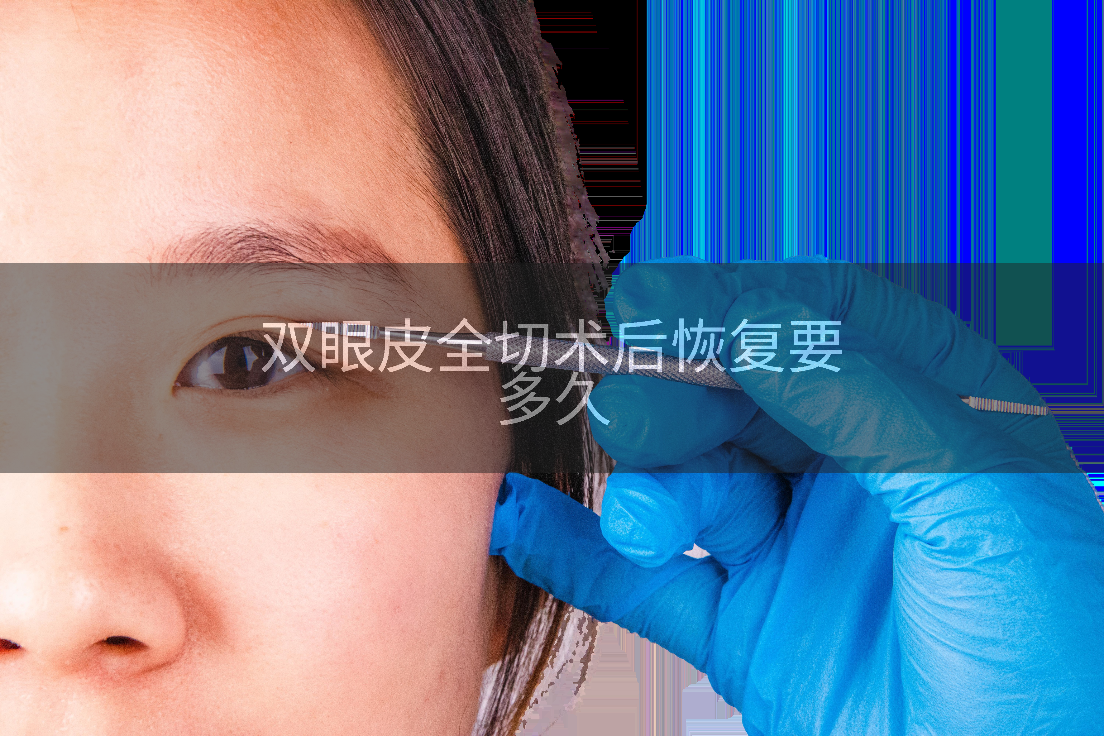 双眼皮全切术后恢复要多久