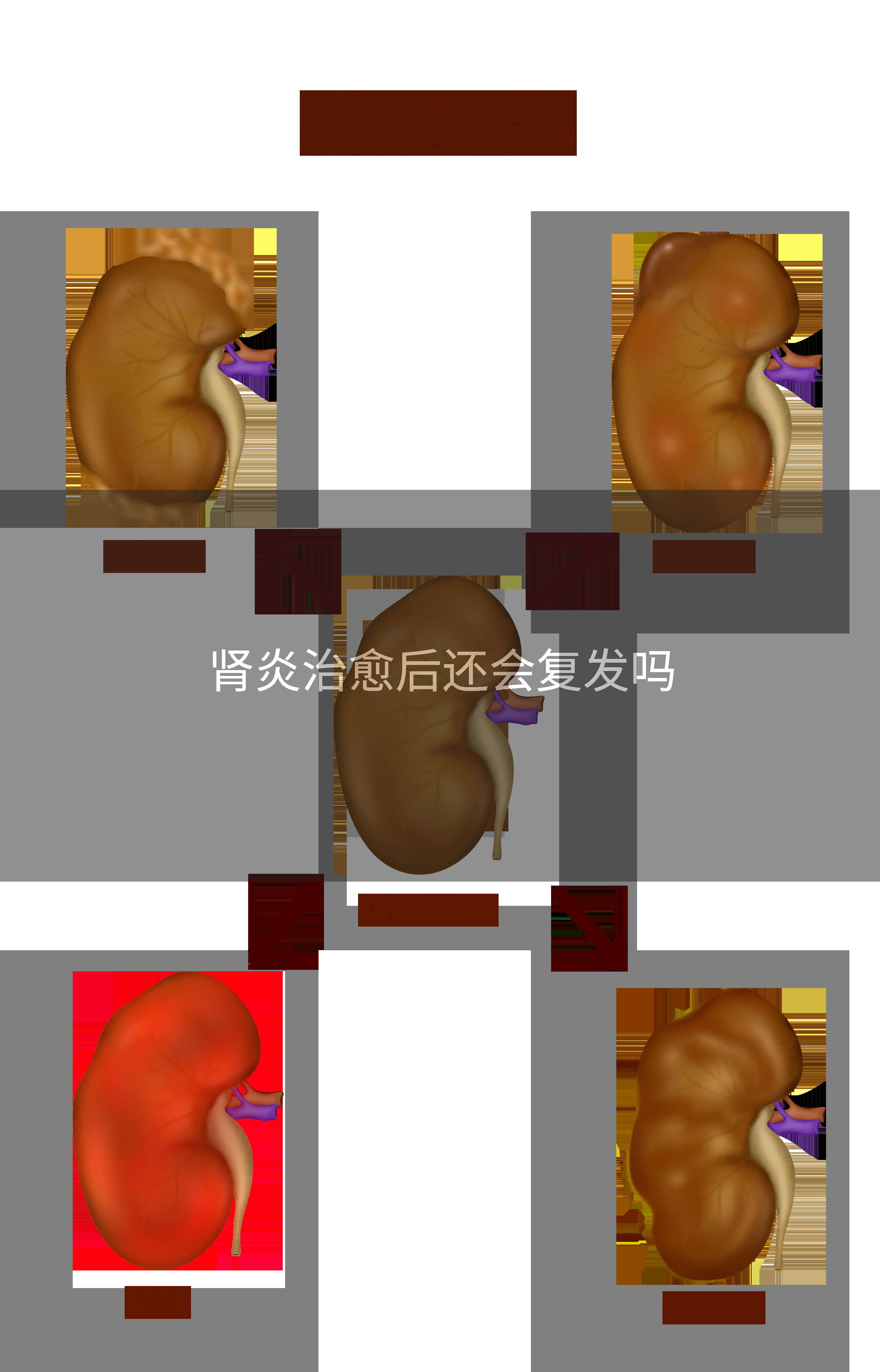 肾炎治愈后还会复发吗