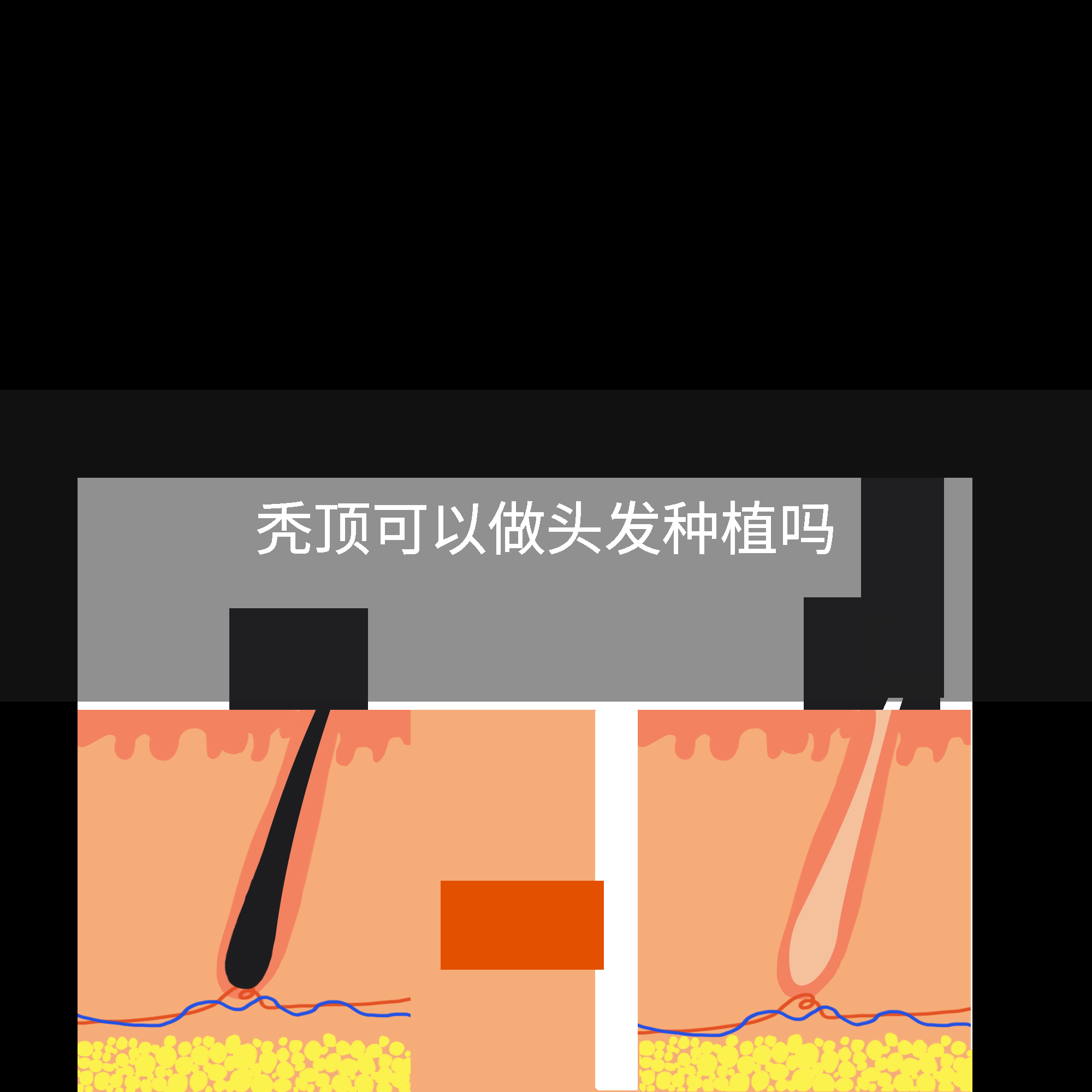 秃顶可以做头发种植吗