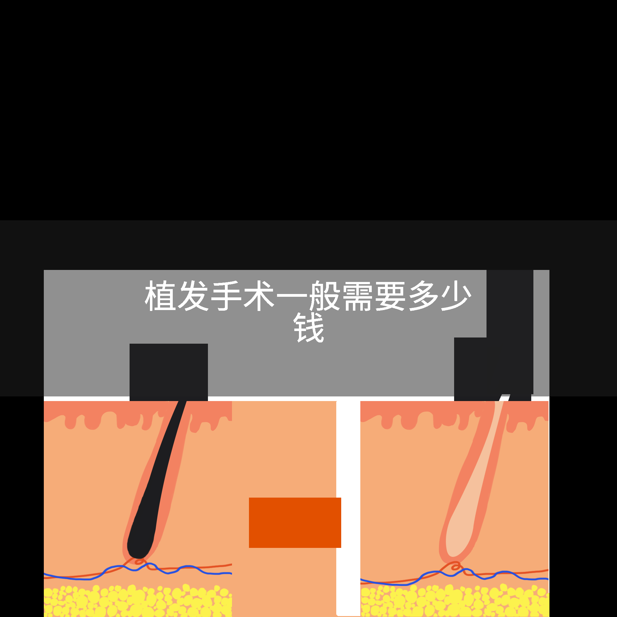 植发手术一般需要多少钱