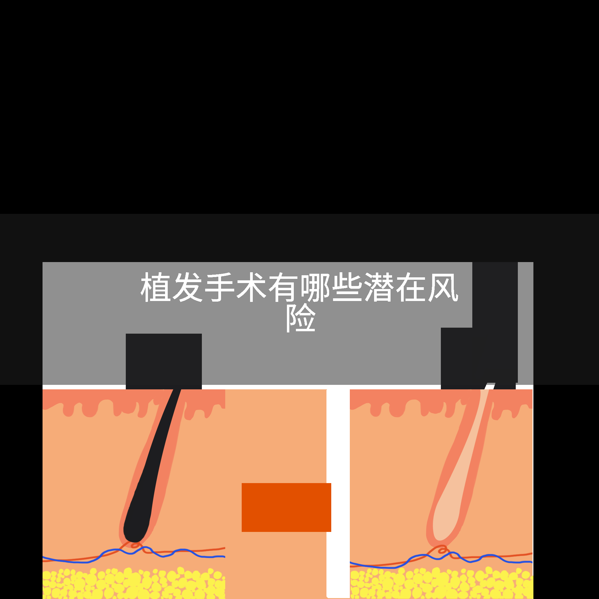 植发手术有哪些潜在风险