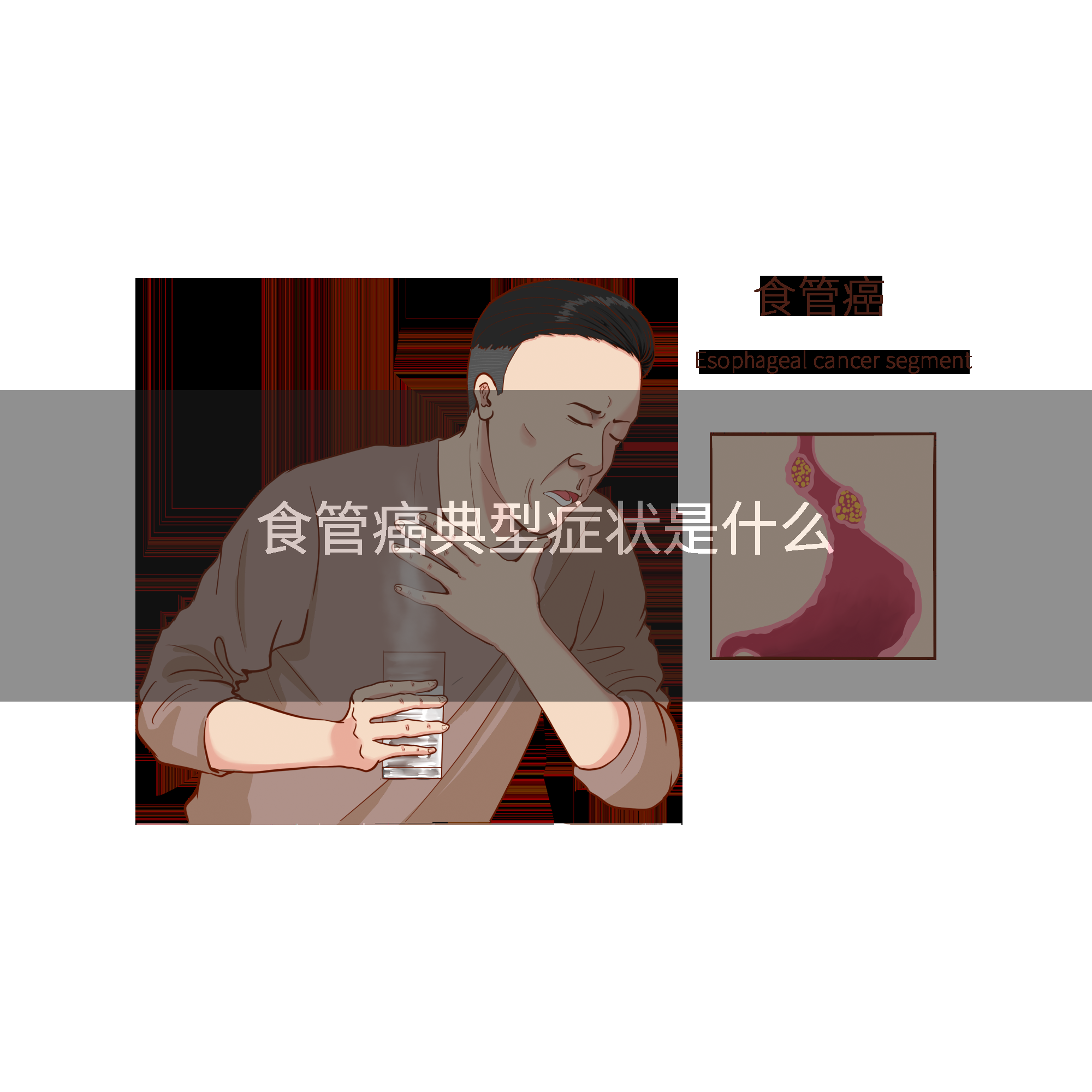 食管癌典型症状是什么