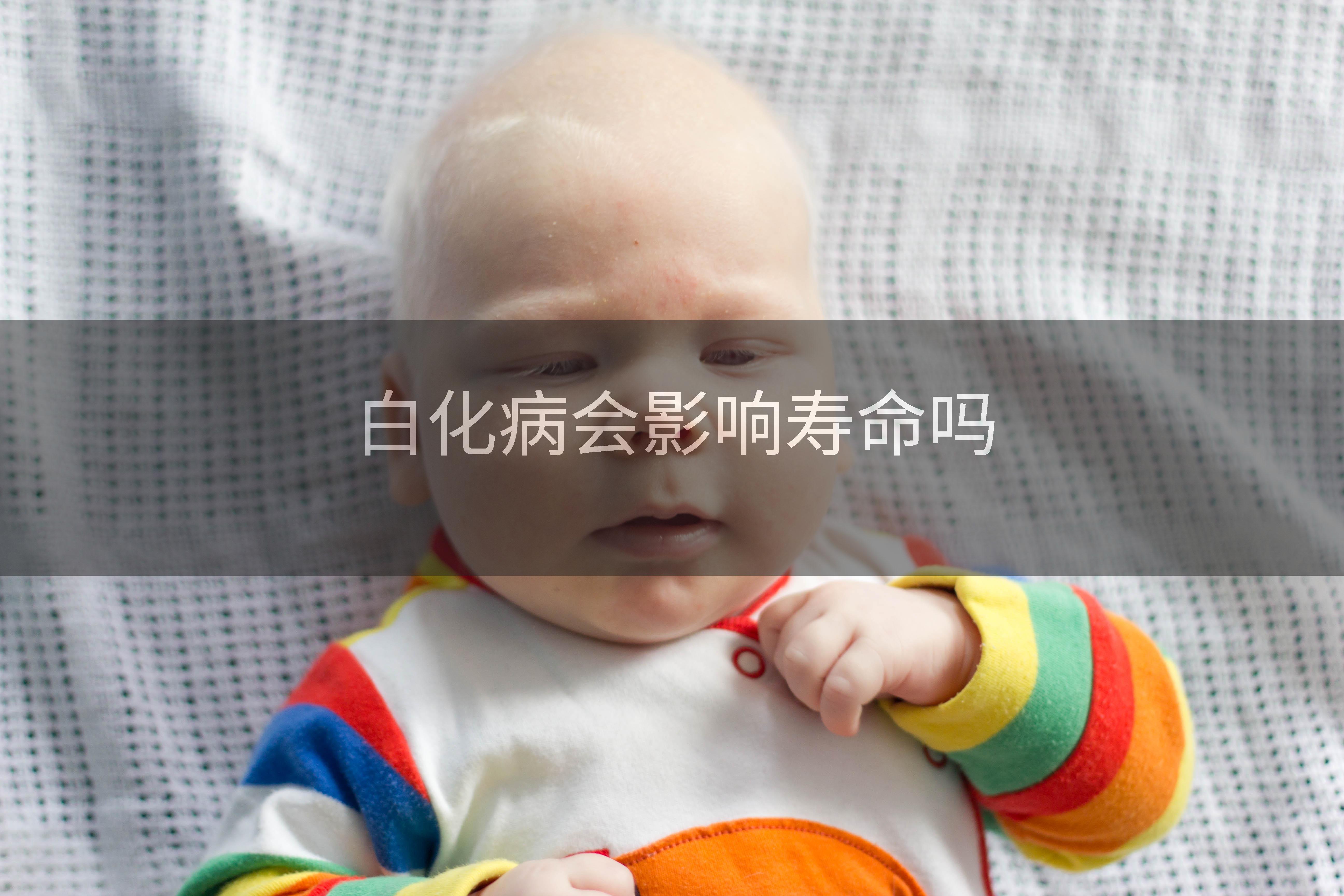 白化病会影响寿命吗