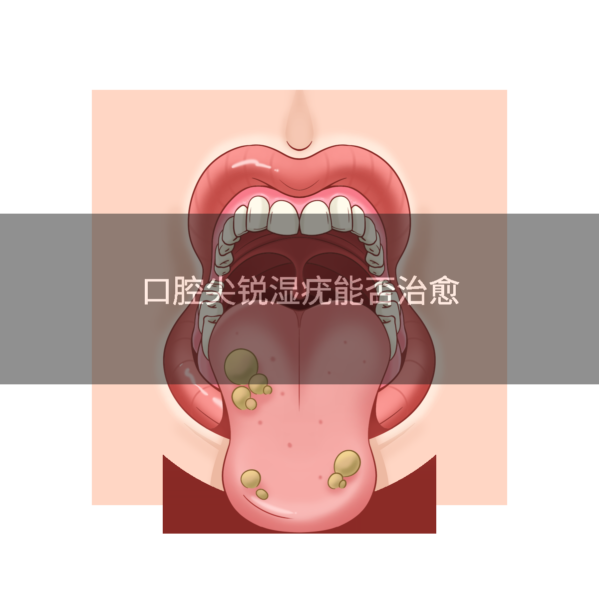 口腔尖锐湿疣能否治愈