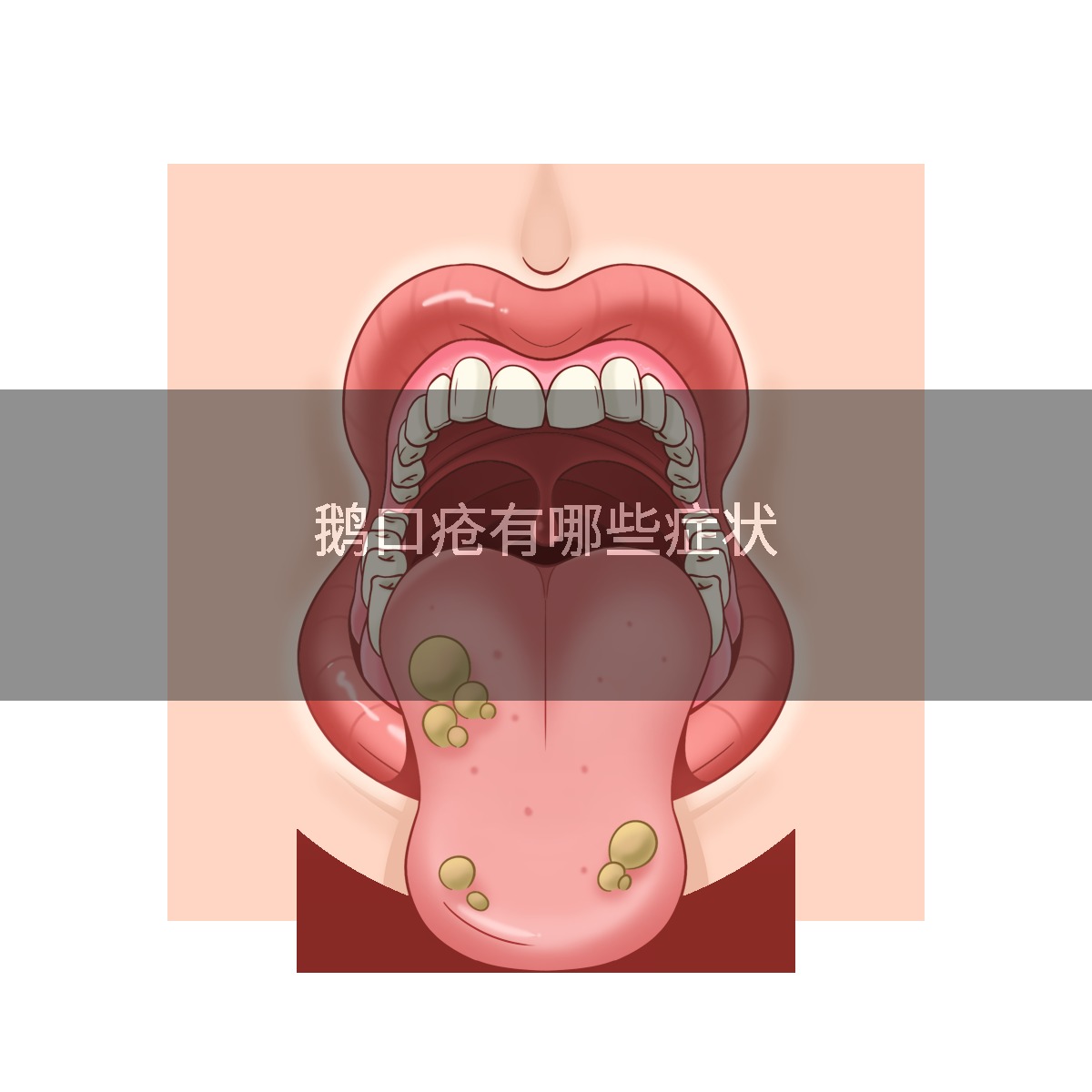 鹅口疮有哪些症状