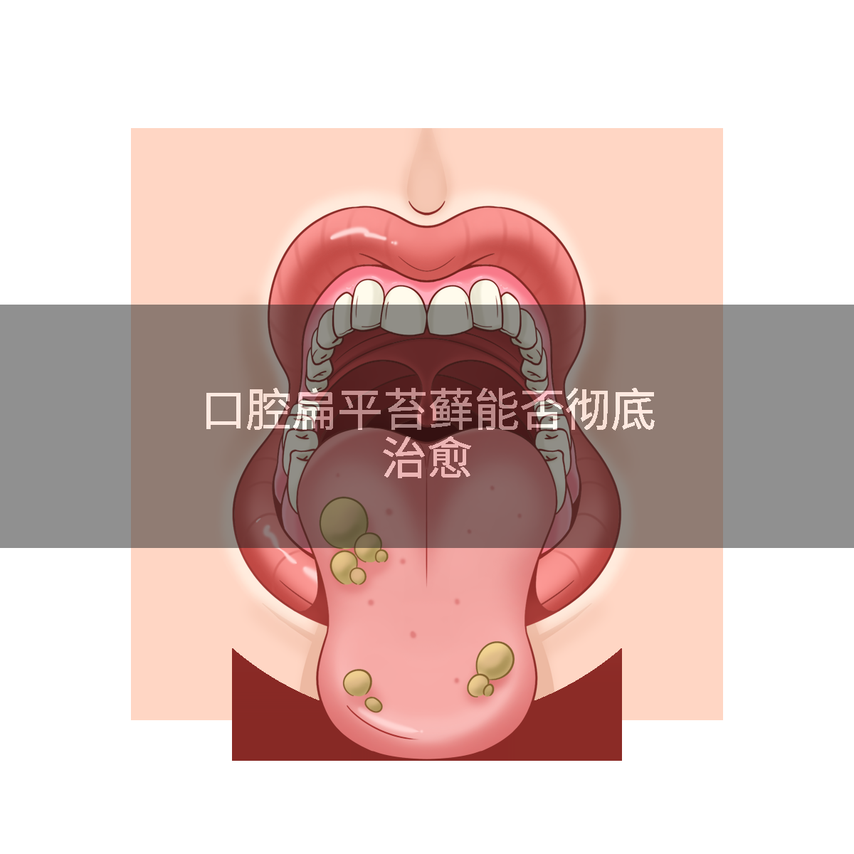 口腔扁平苔藓能否彻底治愈