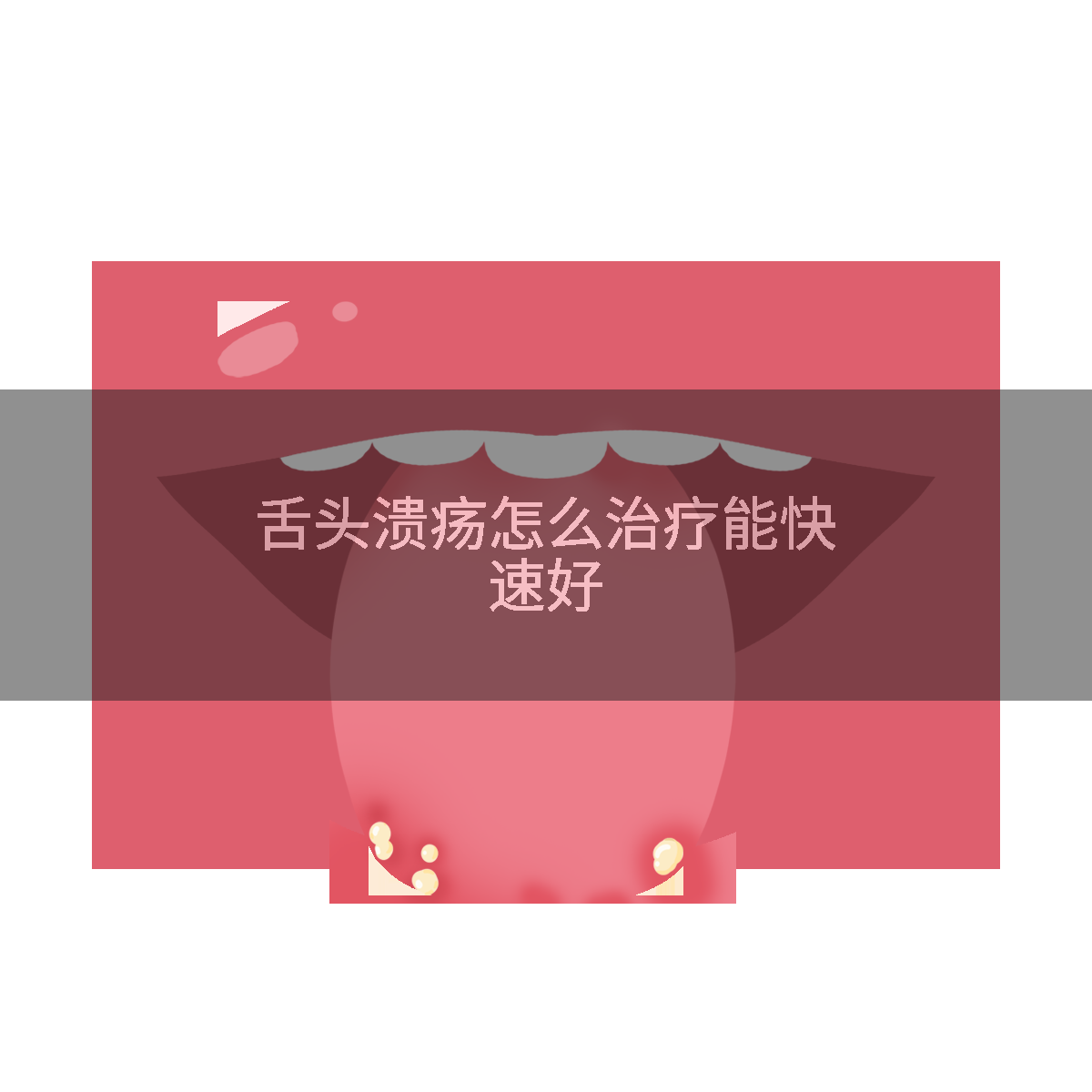 舌头溃疡怎么治疗能快速好