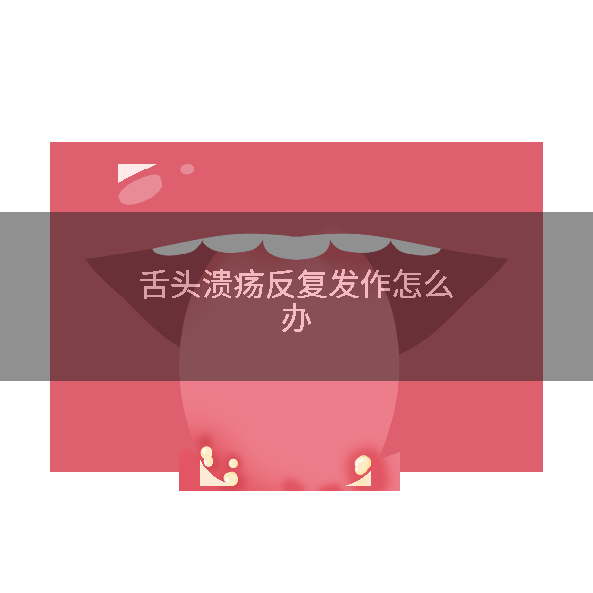 舌头溃疡反复发作怎么办