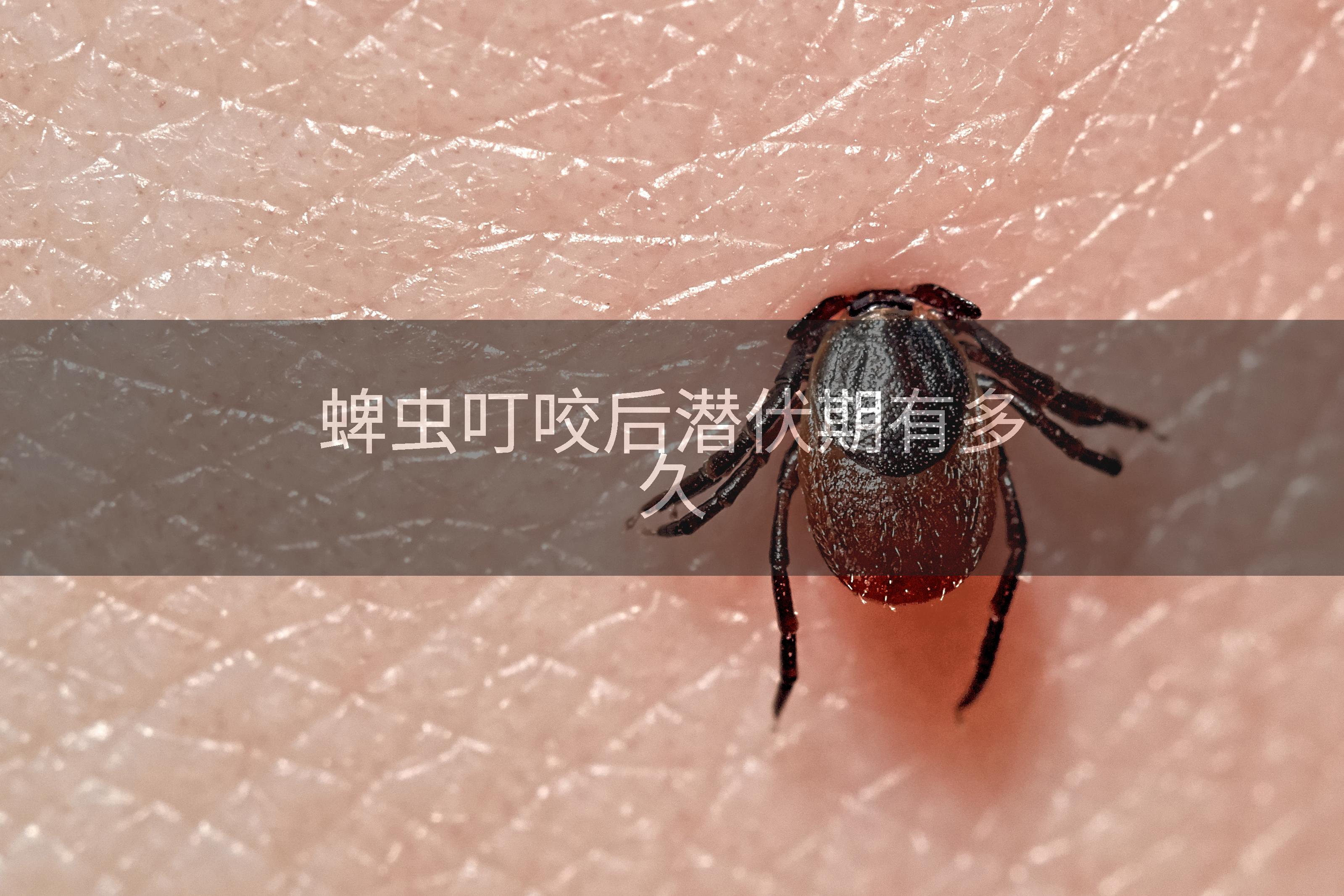 蜱虫叮咬后潜伏期有多久