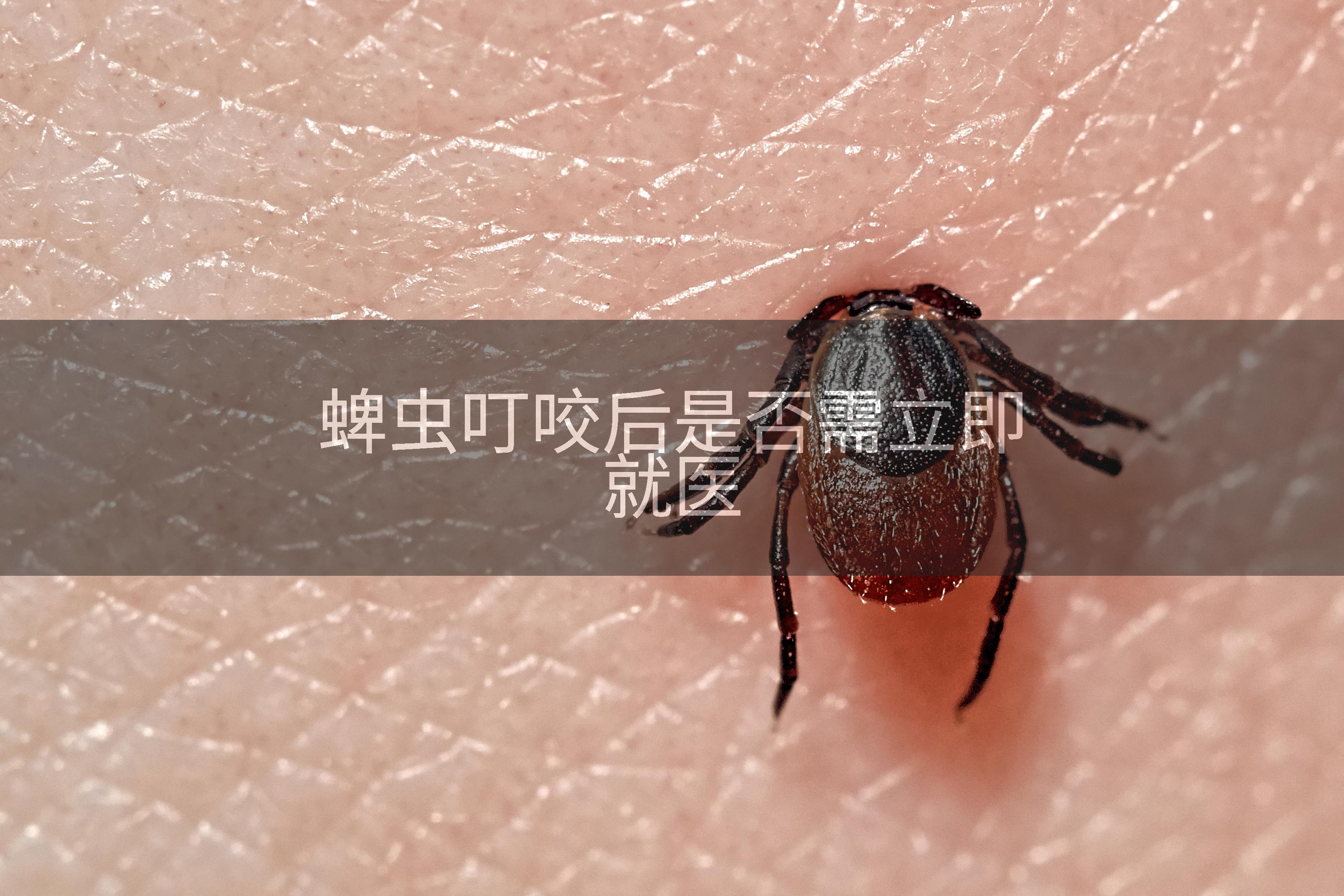 蜱虫叮咬后是否需立即就医
