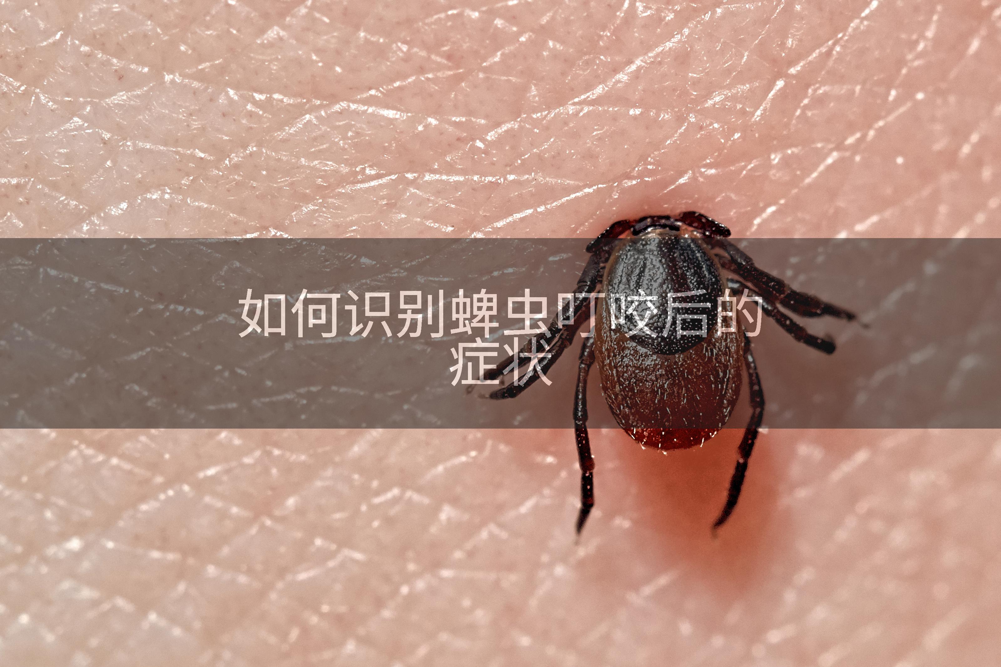 如何识别蜱虫叮咬后的症状