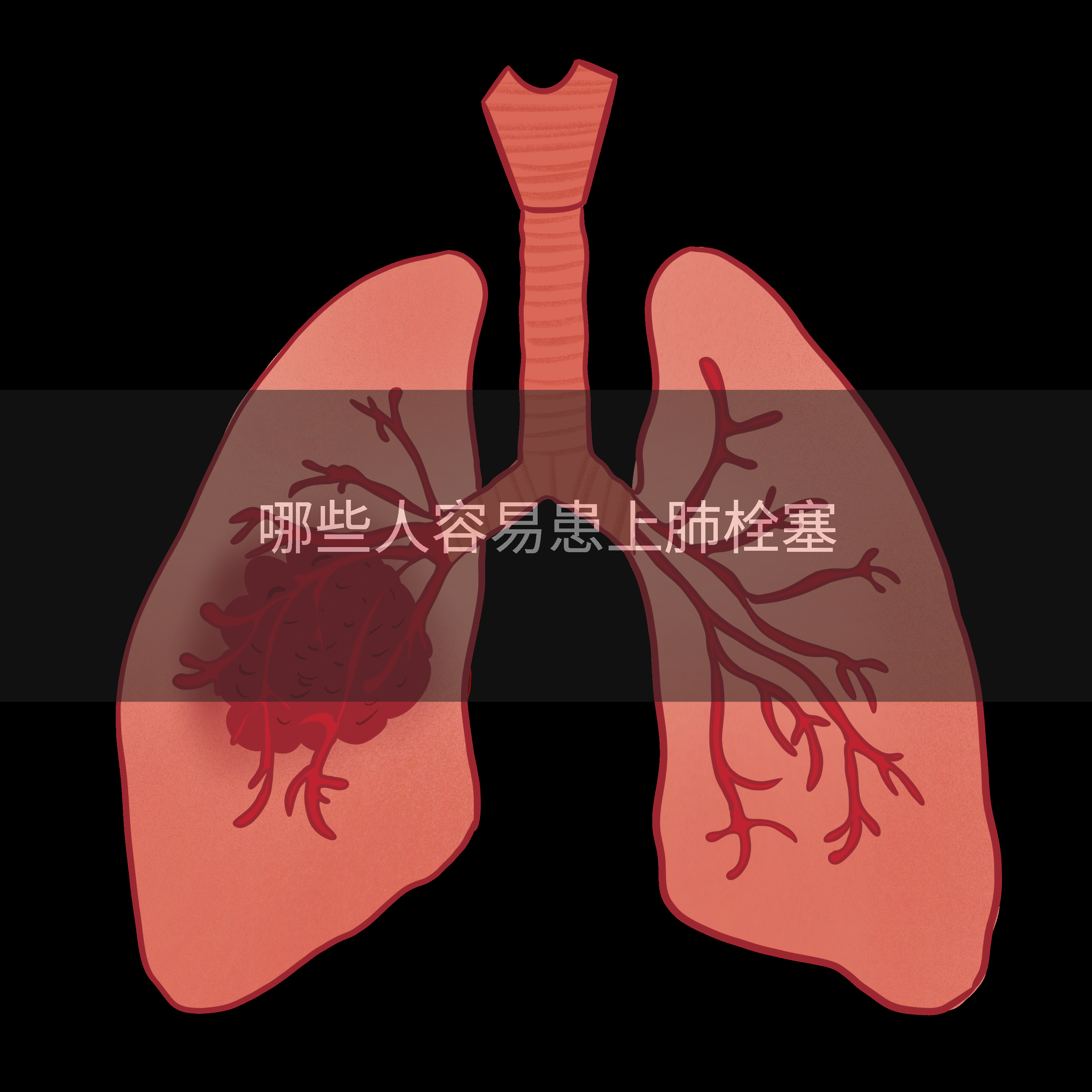 哪些人容易患上肺栓塞