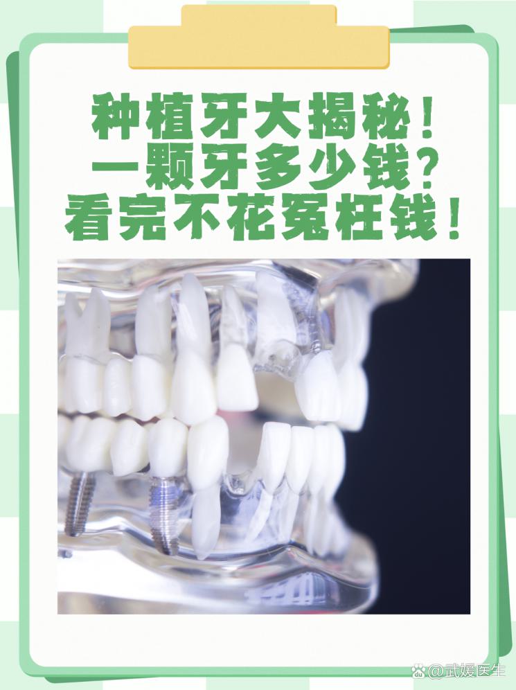种植牙大揭秘！一颗牙多少钱？看完不花冤枉钱！