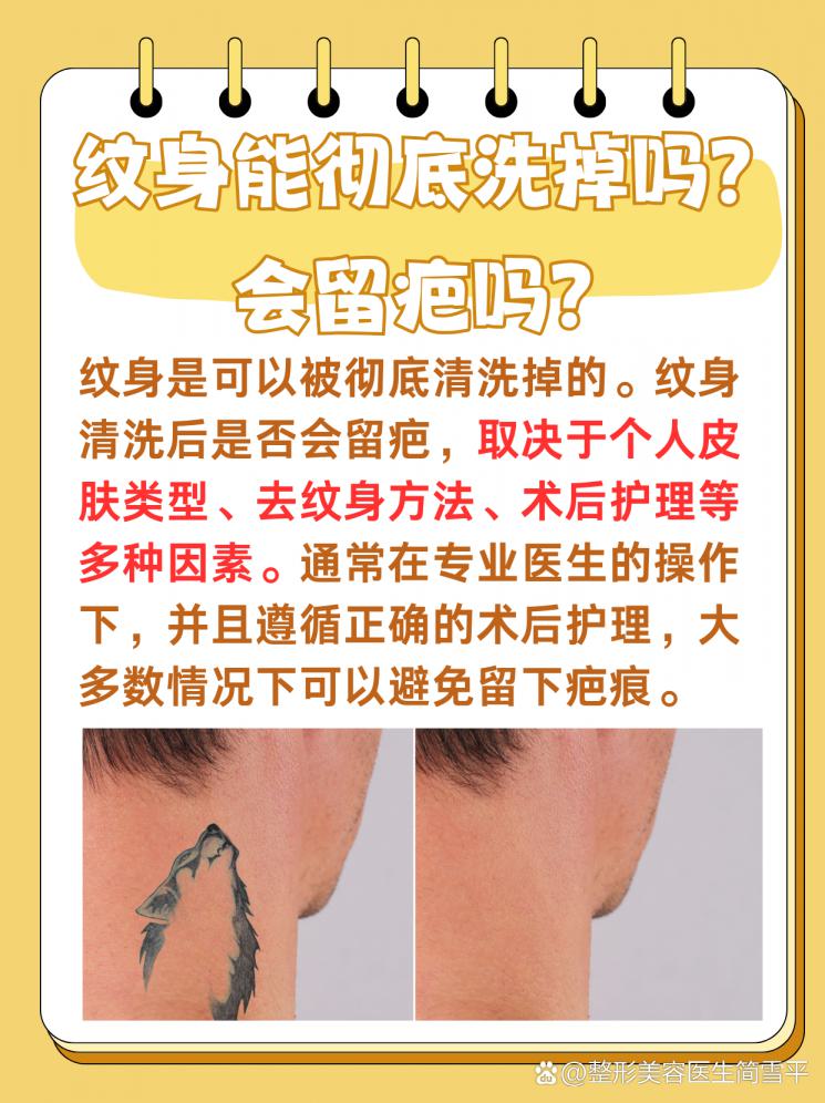 纹身能彻底洗掉吗？会留疤吗？一文揭秘！