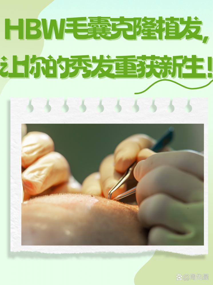 HBW毛囊克隆植发，让你的秀发重获新生！