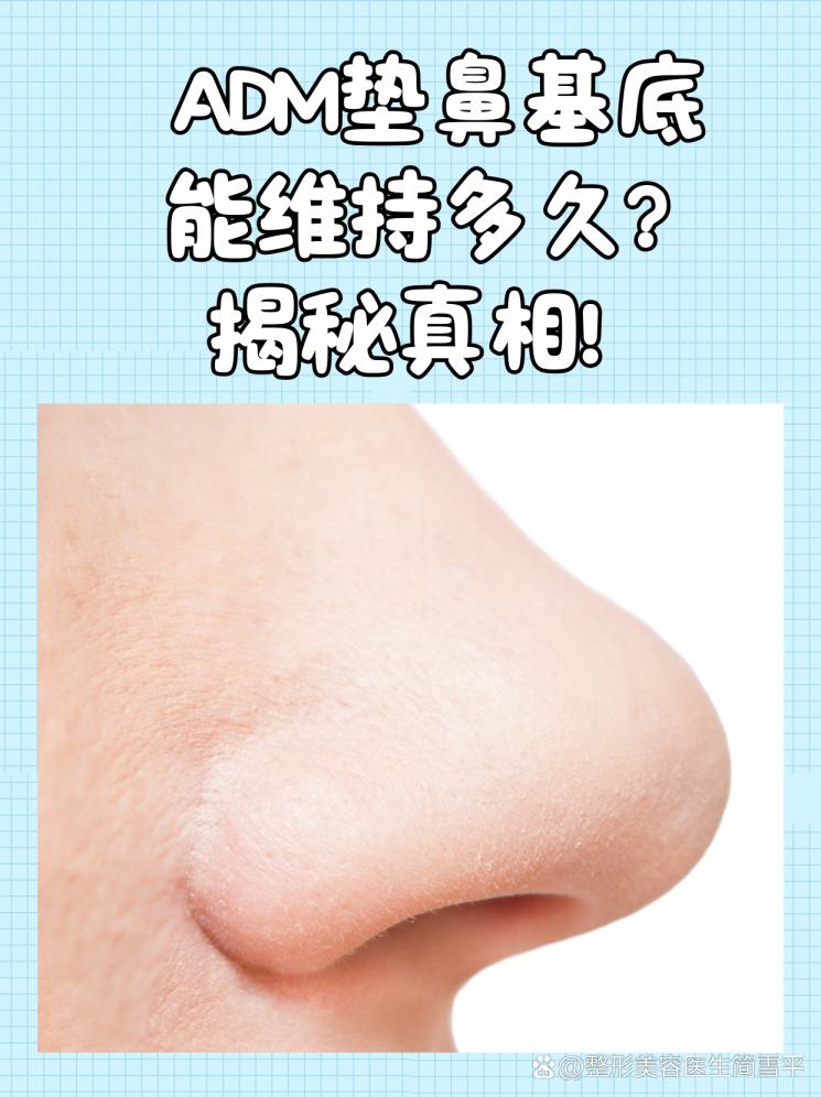 ADM垫鼻基底能维持多久？揭秘真相！