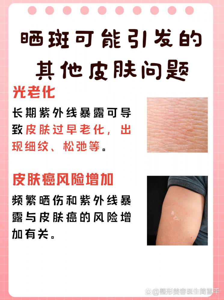 晒斑克星：揭秘晒后快速美白秘籍