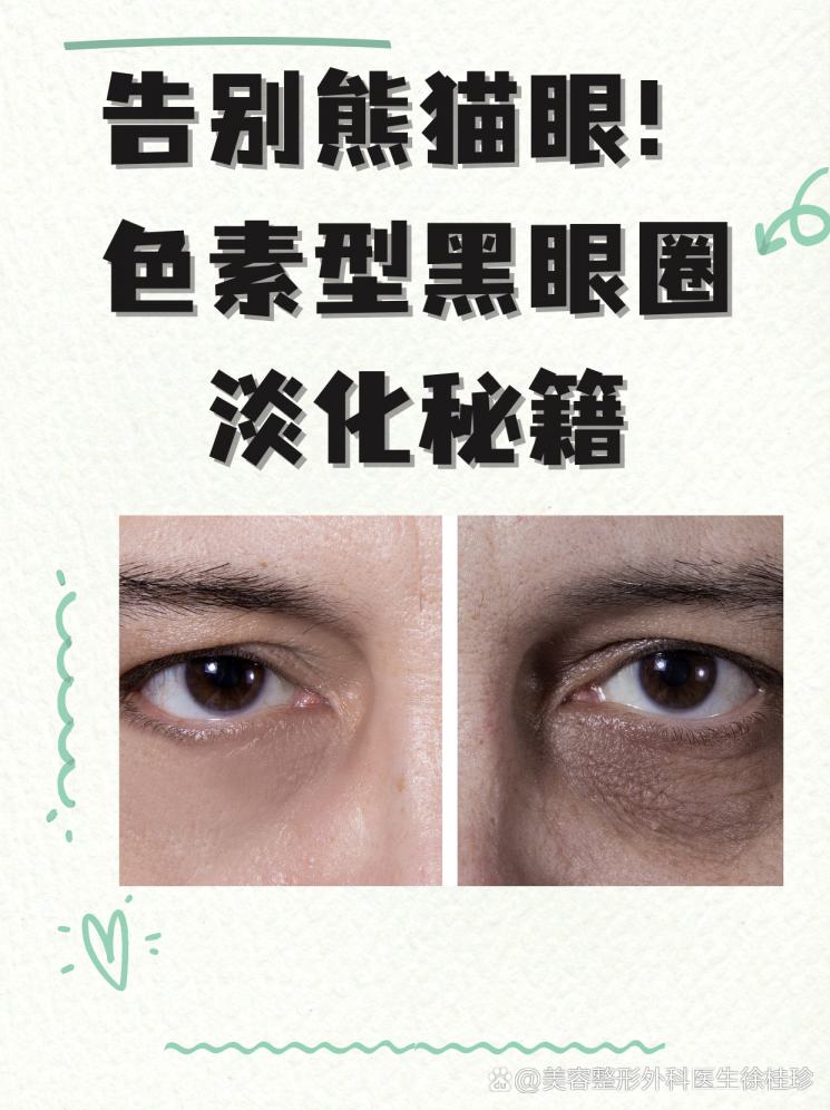 告别熊猫眼！色素型黑眼圈淡化秘籍