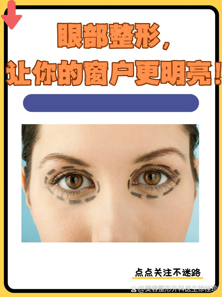 眼部整形，让你的窗户更明亮！