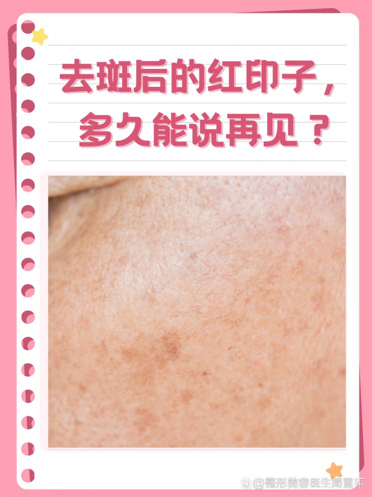 去斑后的红印子，多久能说再见？