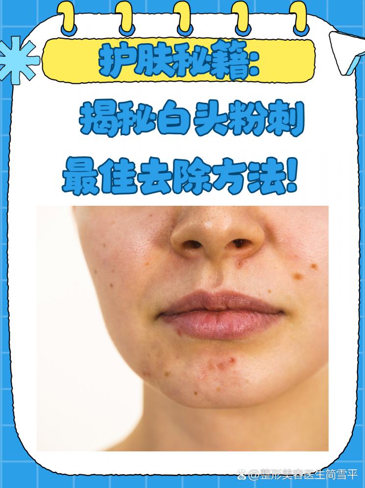护肤秘籍：揭秘白头粉刺最佳去除方法！