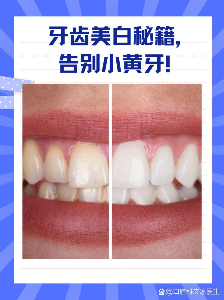 牙齿美白秘籍，告别小黄牙！